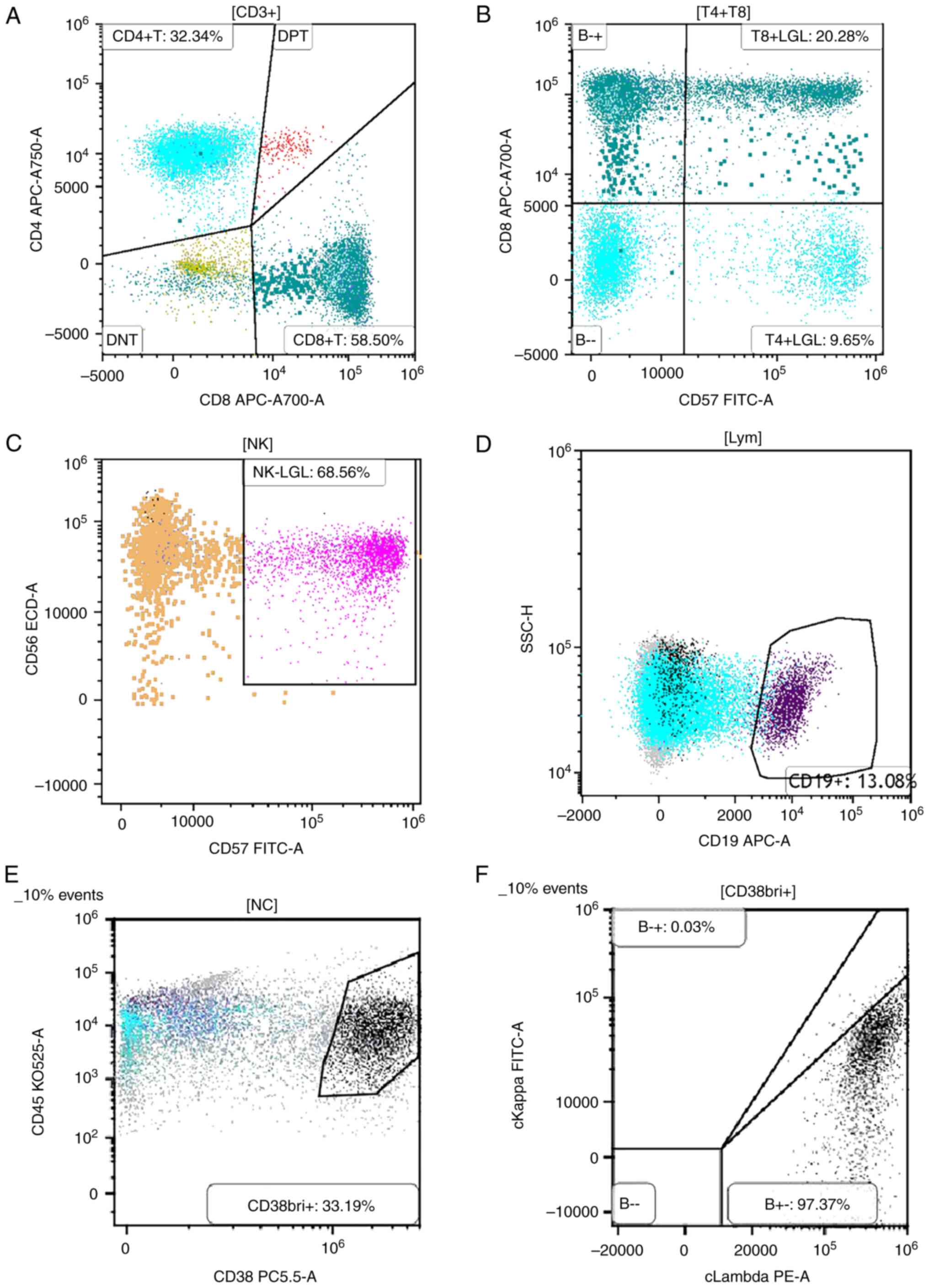 Flow cytometric immunophenotyping of
bone marrow cells from a patient with PCM. (A) Lymphocyte analysis
showing a decreased CD4/CD8 ratio. (B and C) Quantification of
CD57⁺ LGLs, demonstrating a normal proportion of this subset. (D)
Marked expansion of plasma cells detected within the bone marrow
aspirate. (E) Dual-parameter plot of CD38 and CD45 expression
revealing a distinct CD38bright+/CD45dim+
population, accounting for 33.19% of total nucleated cells,
consistent with malignant plasma cell infiltration. (F)
Intracellular immunoglobulin light chain staining within the
CD38bright+ population indicating prominent λ light
chain restriction (97.37%) with minimal κ expression (0.03%),
confirming clonal proliferation and supporting the diagnosis of
PCM. LGLs, large granular lymphocytes; NC, nucleated cell; PCM,
plasma cell myeloma; A, allophycocyanin-Alexa Fluor 700; APC,
allophycocyanin; CD38bri+, CD38 bright positive; DNT,
double negative T cells; DPT, dual-parameter plot; ECD,
energy-coupled dye; H, height parameter; KO525, Krome Orange 525;
Lym, lymphocytes; NK, natural killer cells; PC5.5,
phycoerythrin-cyanine 5.5; PE, phycoerythrin; SSC, side
scatter.