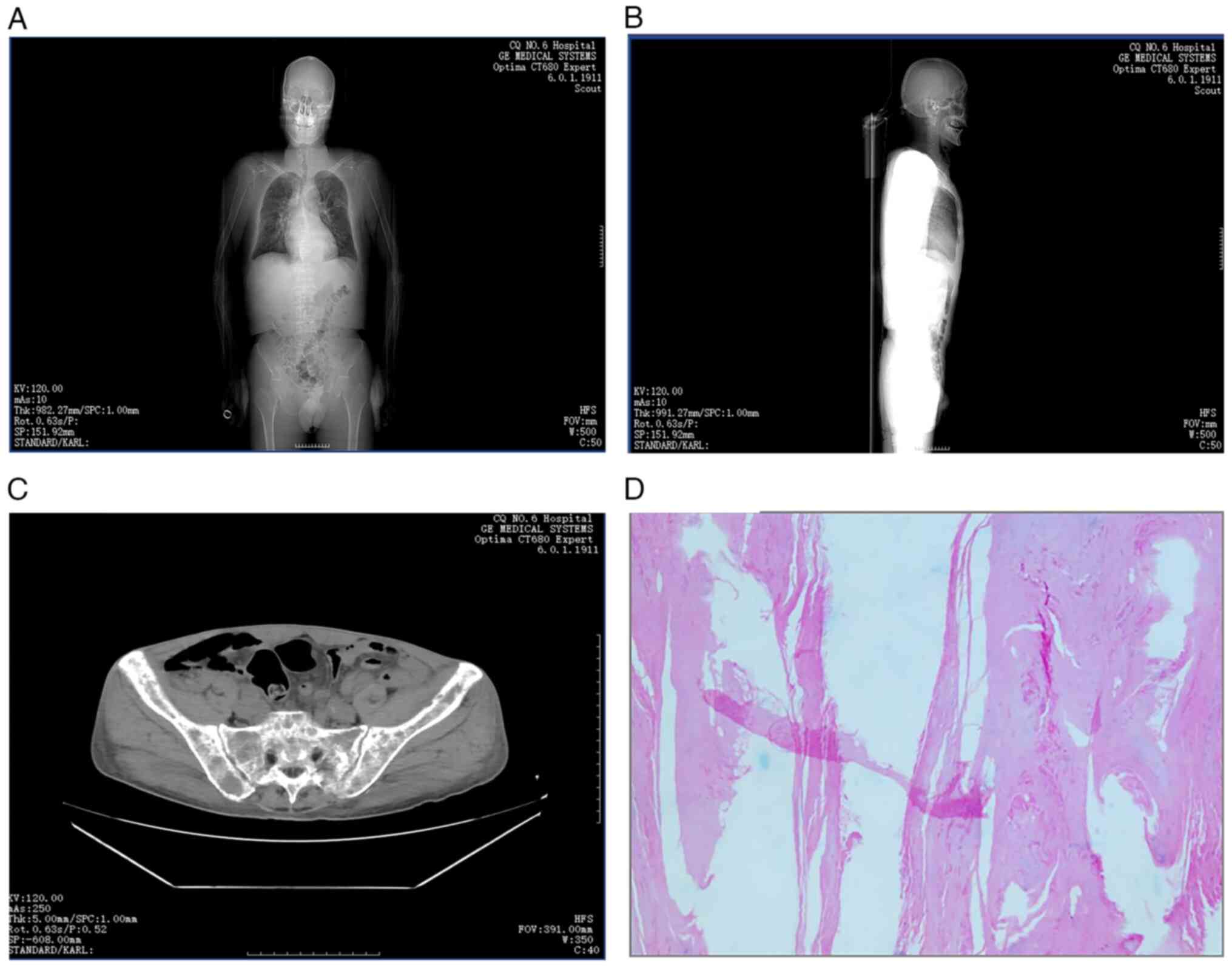 Comprehensive imaging and
histopathological evaluation. (A) An anterior scout image from CT
demonstrated diffuse skeletal involvement, including multiple
hypodense lesions in the skull, ribs, spine, scapulae and pelvis,
consistent with lytic lesions seen in multiple myeloma. Bilateral
pulmonary infections and pleural thickening were also visible. (B)
A lateral scout image further illustrated spinal abnormalities,
including compression of the T12 vertebral body and suspected
Hsu-Mo nodule at T1, as well as degenerative spinal changes. (C) An
axial pelvic CT revealed lytic bone lesions, bilateral pathological
rib fractures and pelvic effusion. (D) Histopathological
examination of a skin lesion showed squamous epithelium with marked
hyperkeratosis (hematoxylin and eosin staining; original
magnification, x100), supporting dermatopathological
involvement.