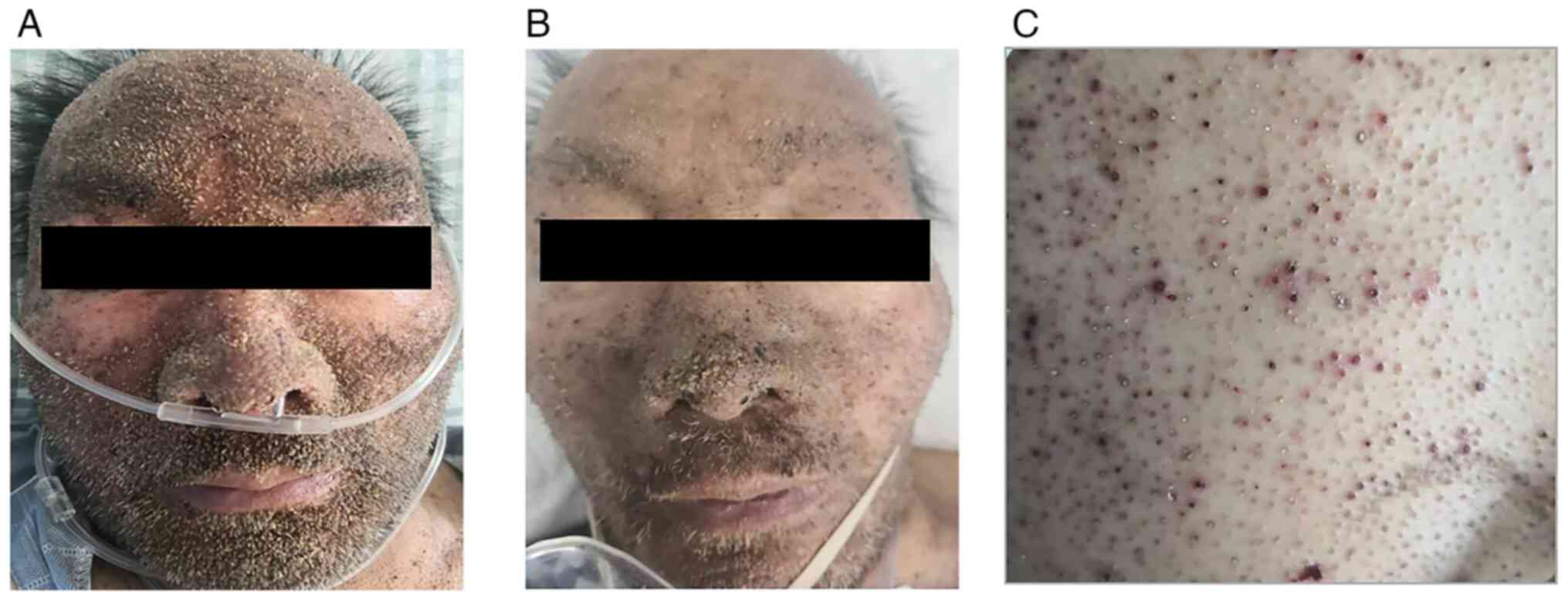 Clinical progression of cutaneous
manifestations and therapeutic response. (A) Pre-treatment image of
the face showing widespread scaling and crusted lesions. (B)
Post-treatment image of the same area with notable resolution of
lesions following systemic corticosteroid therapy. (C) Chest
lesions showing follicular keratotic papules and erythematous
pinpoint eruptions, consistent with follicular spicules of multiple
myeloma.