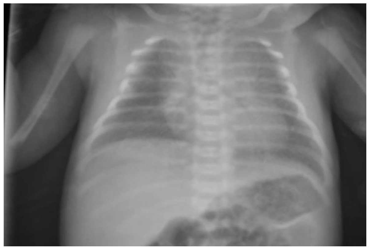 Clinical Radiological And Genetic Analysis Of A Male Infant With Neonatal Respiratory Distress Syndrome