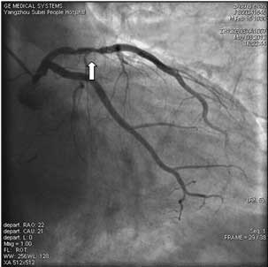 What are some treatments for blockage of the left anterior descending artery?