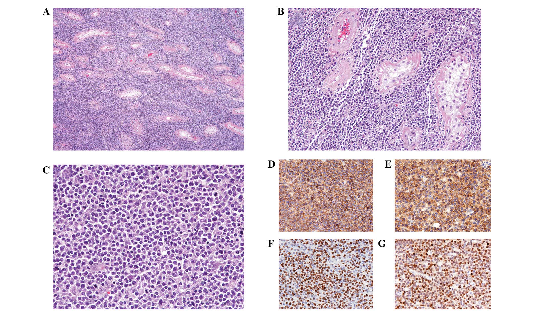 Primary Testicular Diffuse Large B Cell Lymphoma A Case Report