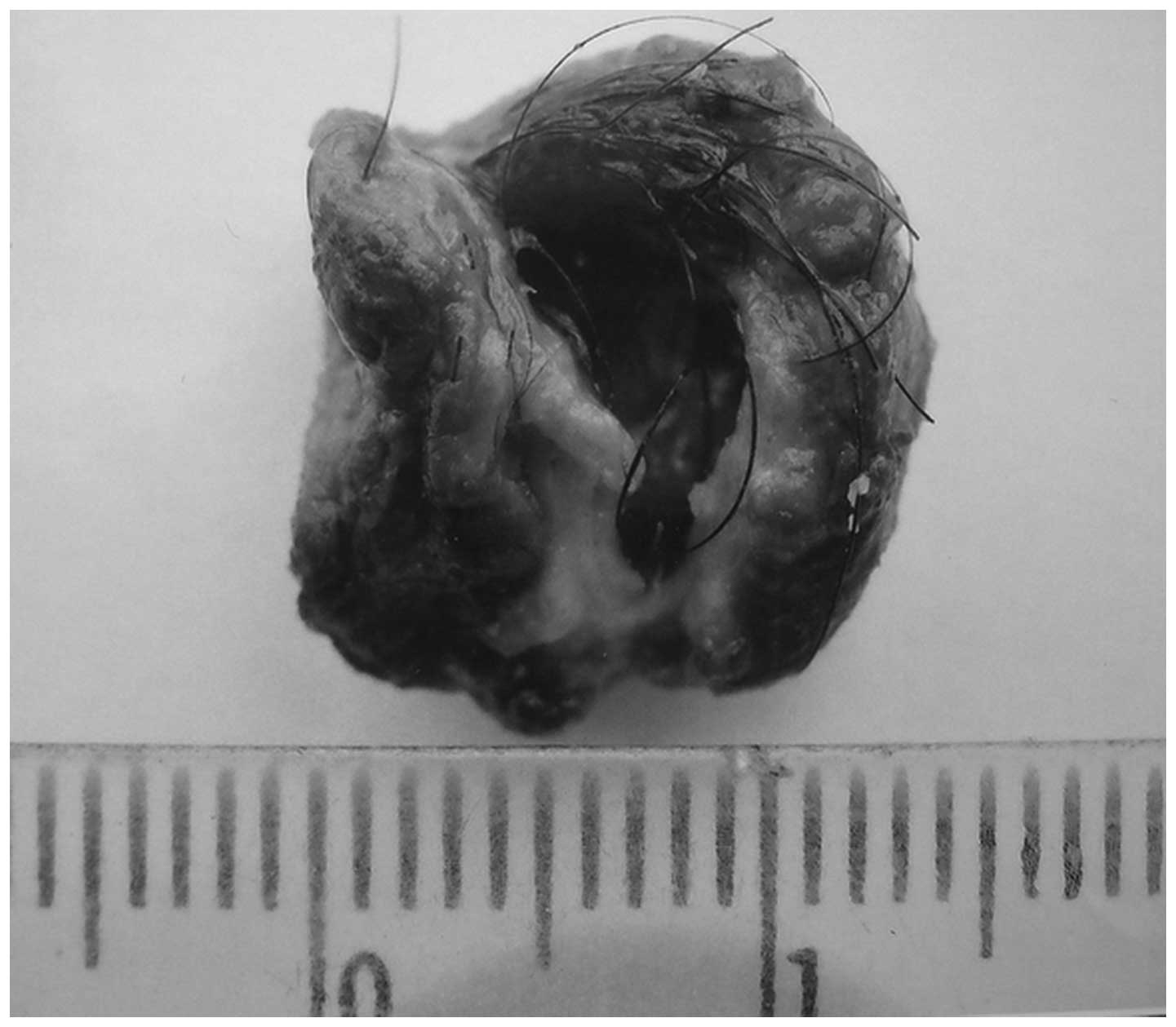 An Unusual Dermoid Cyst In Subcutaneous Tissue Of The Mastoid Region A