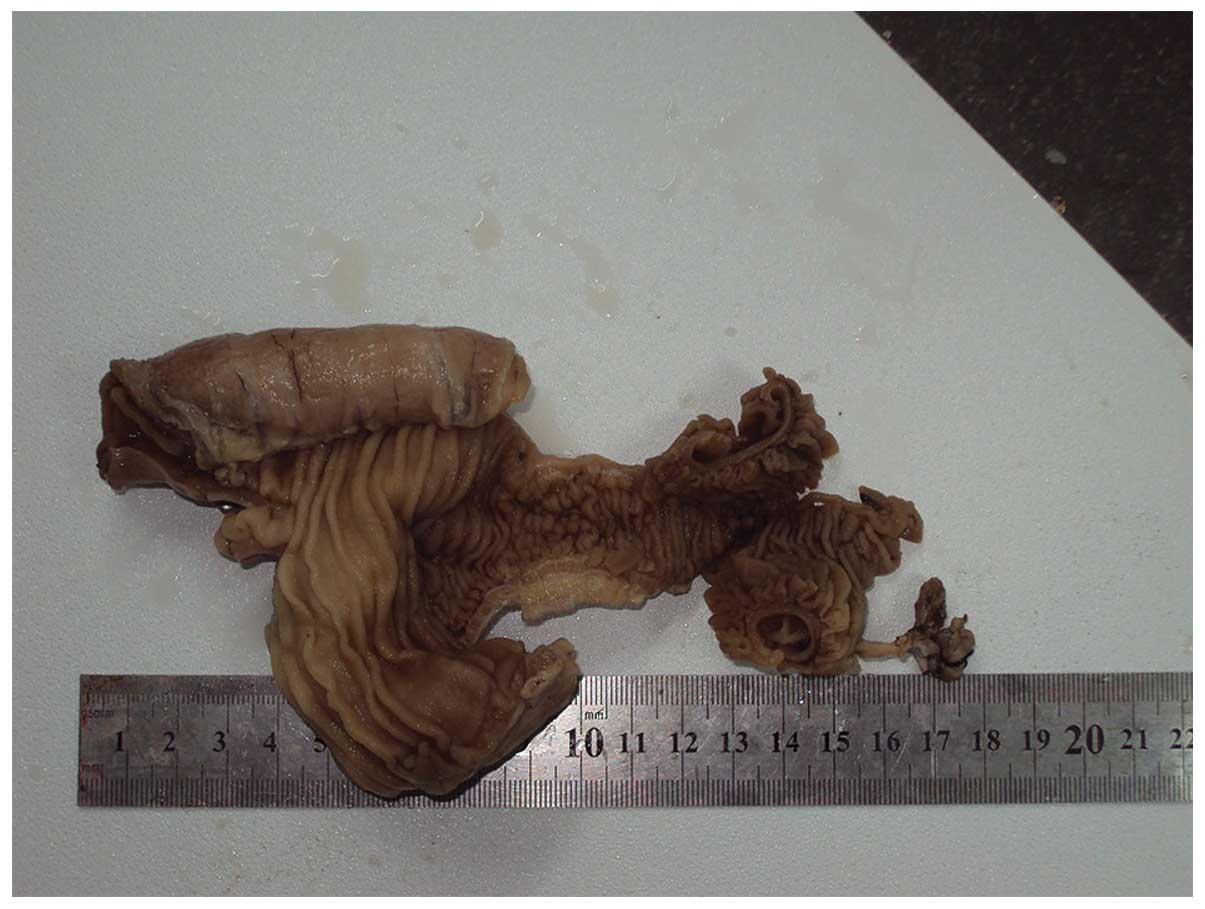 Case Report Of Small Bowel Obstruction, What Causes Narrow Stools
