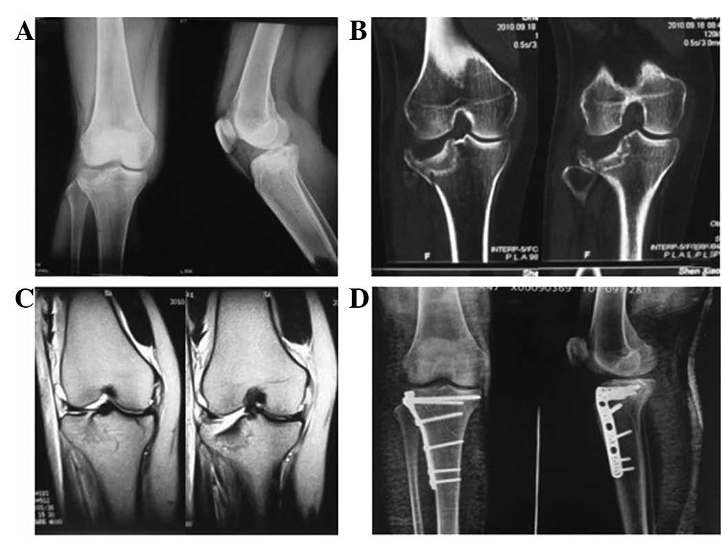 Mdct And Mri For The Diagnosis Of Complex Fractures Of The Tibial Plateau A Case Control Study