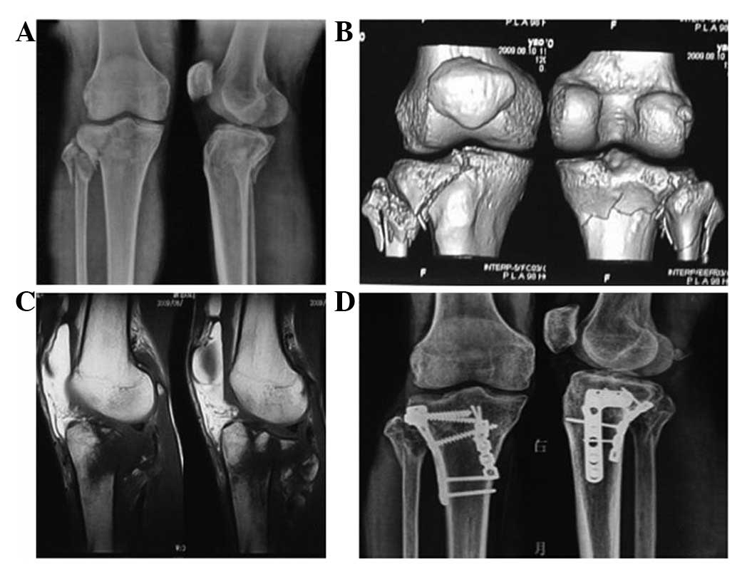 Figure 3 - Male, 39 years old, with a tibial plateau fracture of the right tibi...