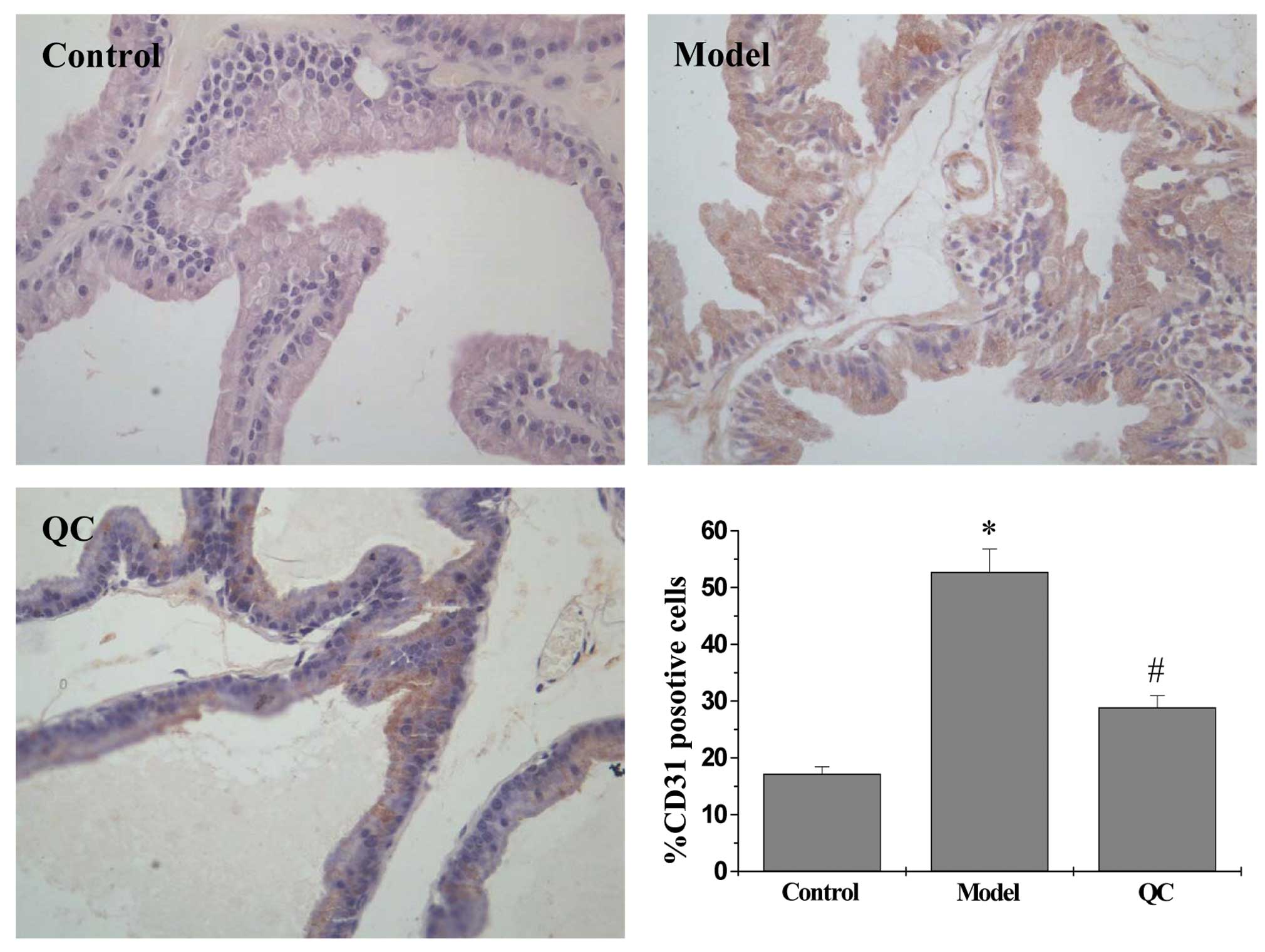 benign prostate hyperplasia ncbi