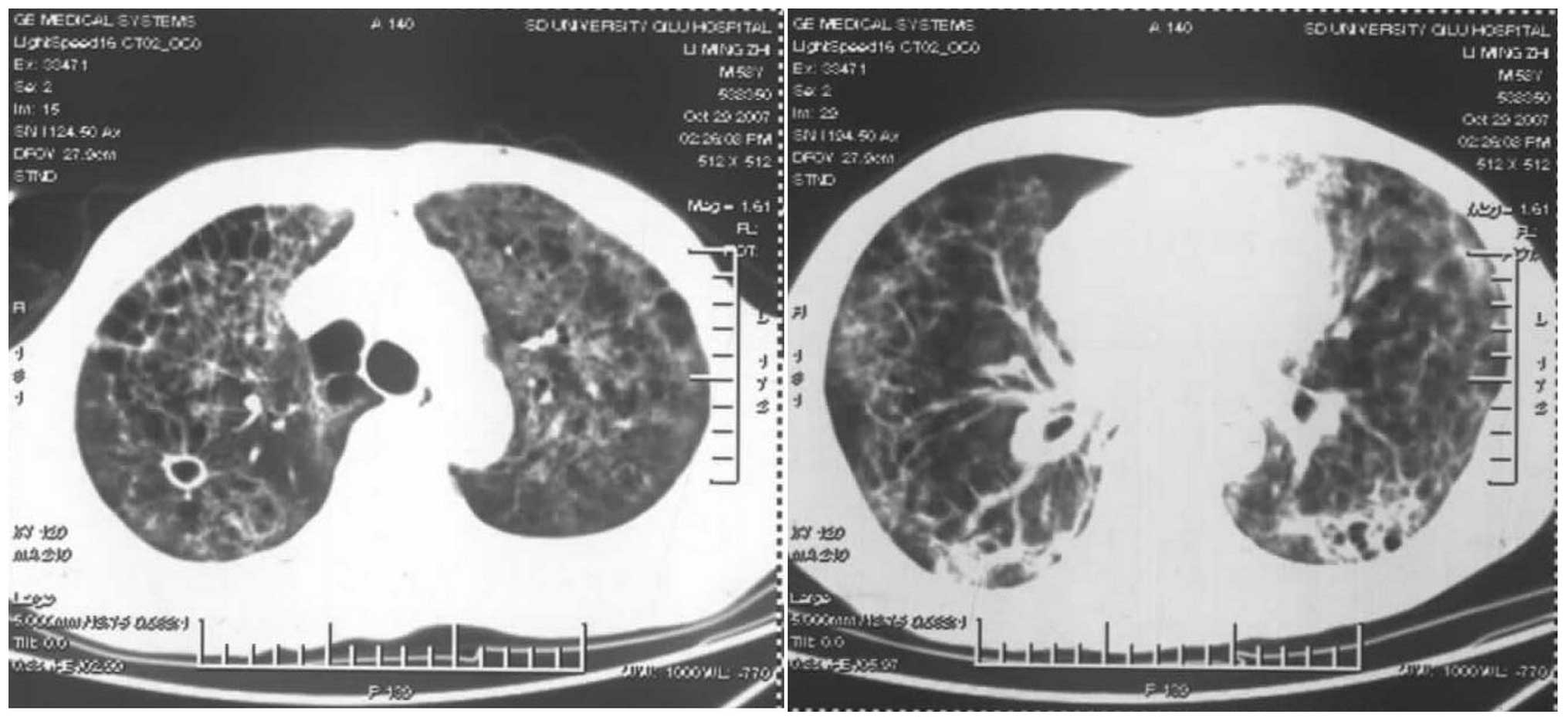 is mesothelioma considered lung cancer