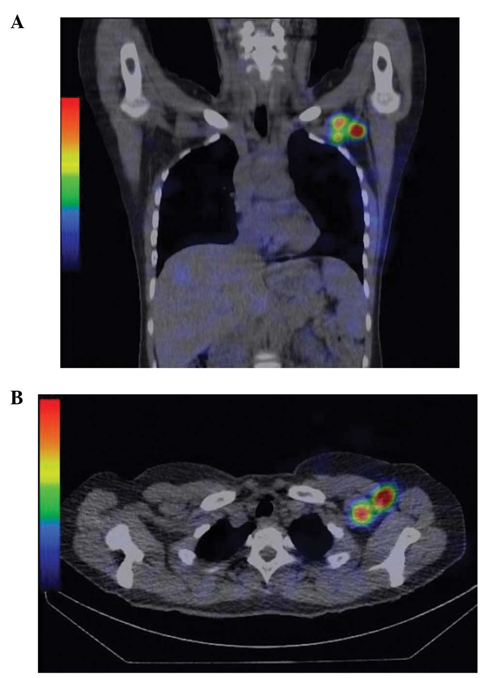 Lymph Node Ct Scan Contrast