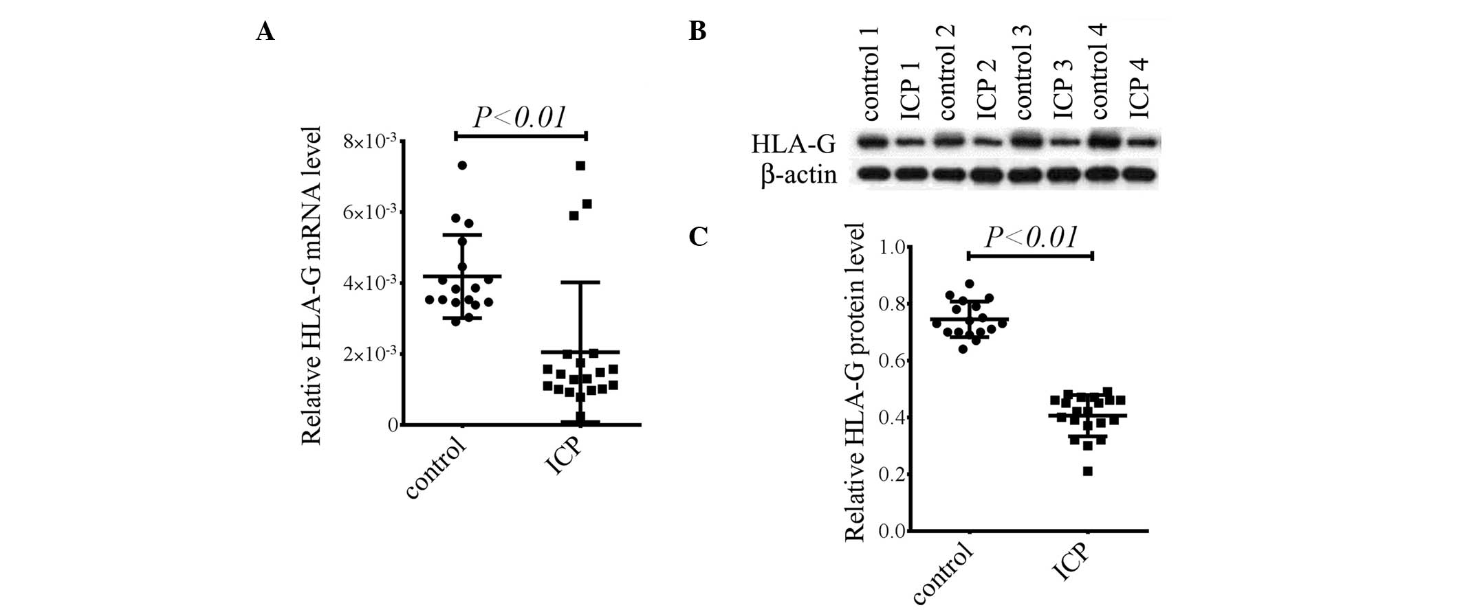 Human leukocyte antigen G and miR‑148a are associated with ...