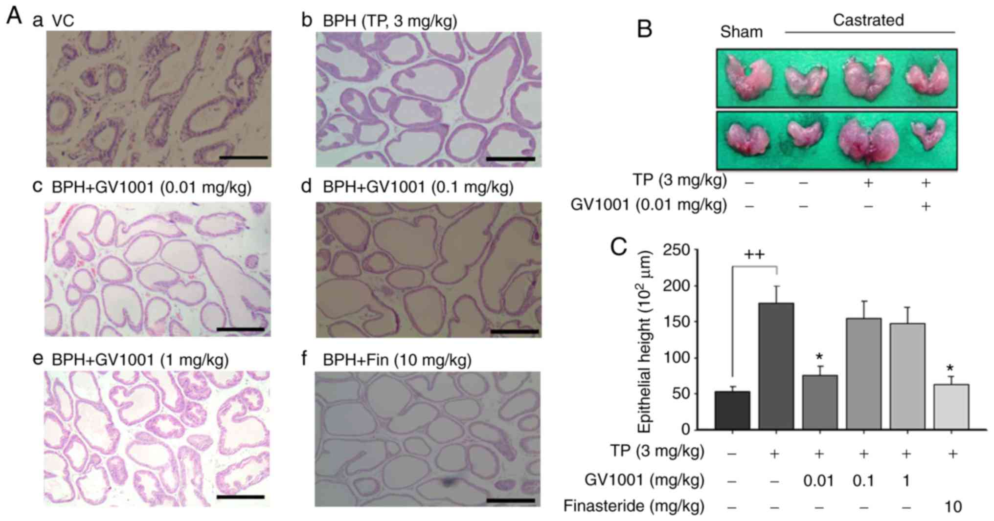 benign prostate hyperplasia ncbi)