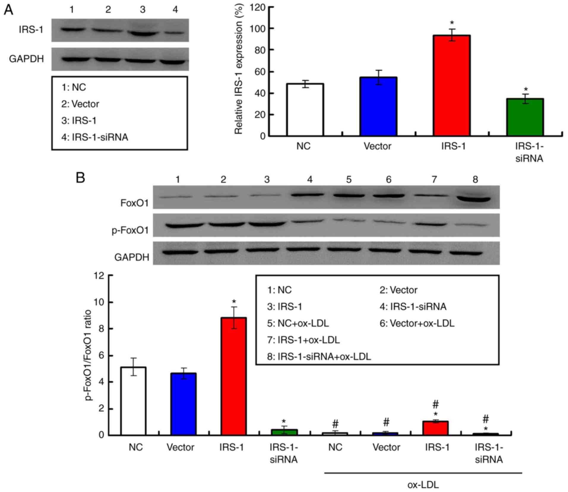 Insulin Receptor Substrate 1 Protects Against Injury In Endothelial Cell Models Of Ox Ldl Induced Atherosclerosis By Inhibiting Er Stress Oxidative Stress Mediated Apoptosis And Activating The Akt Foxo1 Signaling Pathway