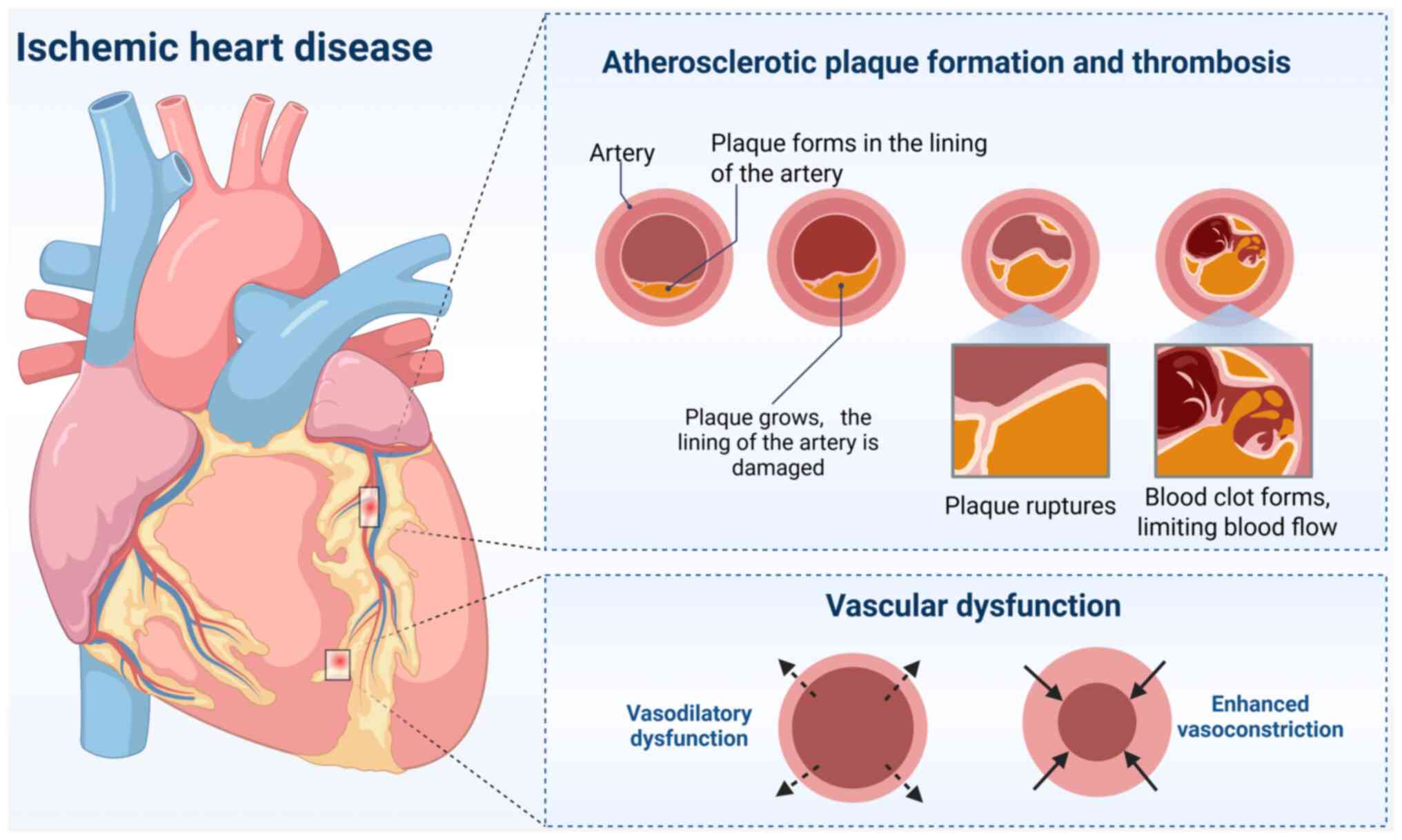 Pathological mechanisms of IHD. The
top right section outlines the stages of atherosclerosis: initial
plaque formation, growth, rupture and subsequent thrombus
development limiting blood flow. The bottom right section addresses
vascular dysfunction, showing vasodilatory dysfunction and enhanced
vasoconstriction that further impair coronary circulation and lead
to myocardial ischemia. IHD, ischemic heart disease.