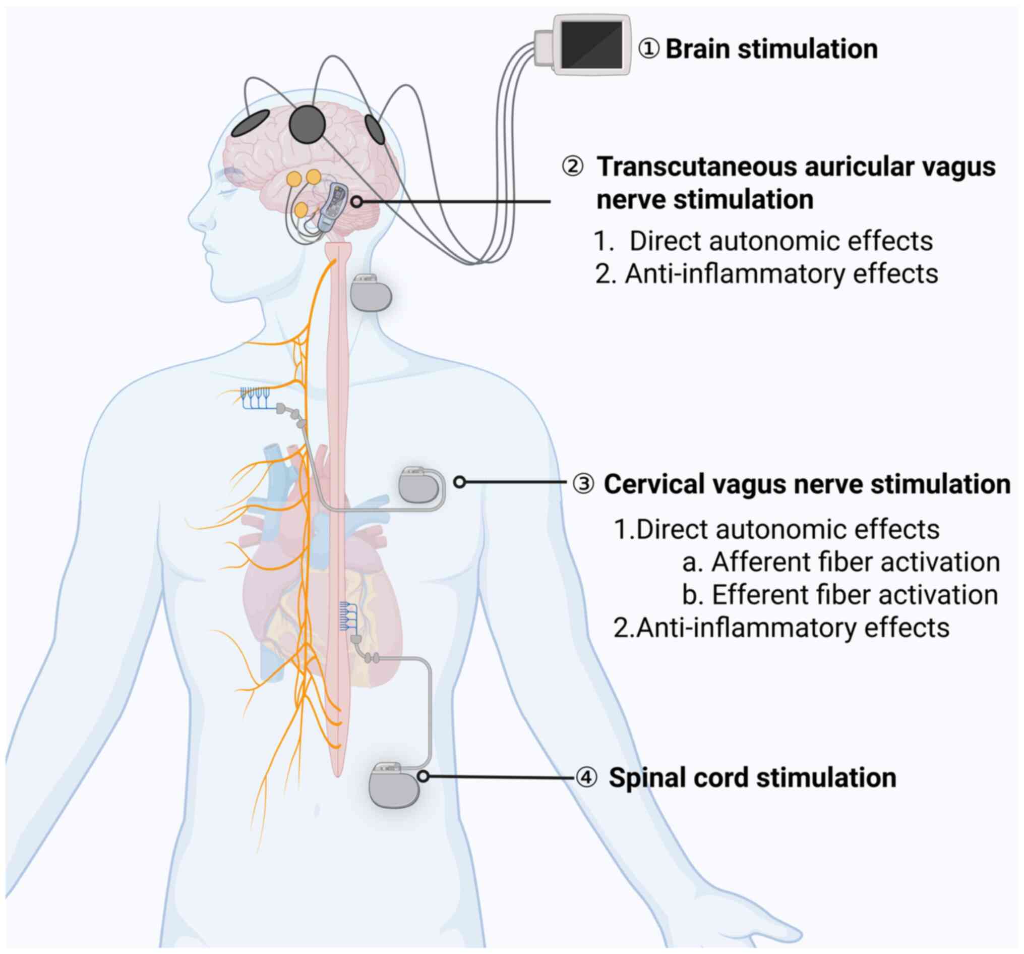 Various neurostimulation techniques
in IHD. 1) Brain stimulation, where devices apply electrical
impulses directly to the brain. 2) Transcutaneous auricular vagus
nerve stimulation, targeting the ear's auricular branch of the
vagus nerve for both direct autonomic effects and anti-inflammatory
benefits. 3) Cervical vagus nerve stimulation, which involves
direct stimulation of the cervical vagus nerve affecting both
afferent and efferent fibers to modulate autonomic function and
inflammation. 4) Spinal cord stimulation, where devices placed
along the spine modulate neurological signals to alleviate pain and
improve cardiovascular function. IHD, ischemic heart disease.