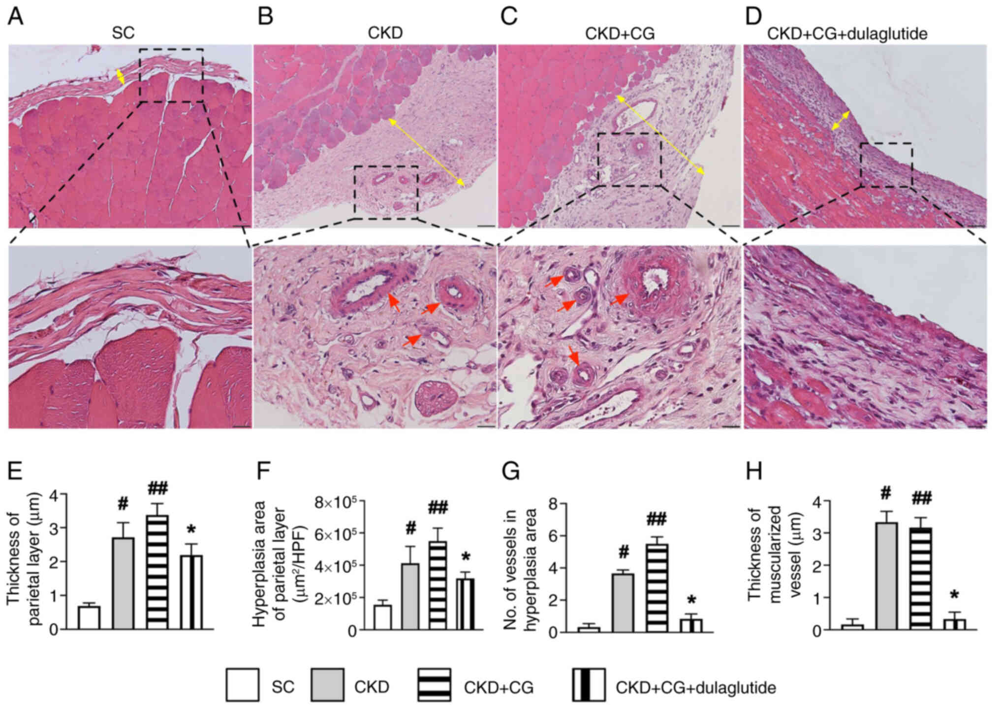 Histopathological findings in the rat
peritonium by day 42 after CKD induction. Light microsope findings
(magnification, ×400) of hematoxylin and eosin staining for the
detection of thickness and hyperplasia (double yellow arrows), as
well as the number of small vessels and muscularized vessels (red
arrows) in the intimmal layer of the peritoneum. Scale bar, 20
µm. Histological images of the (A) SC group, (B) CKD group,
(C) CKD + CG group and (D) CKD + CG + dulaglutide group. (E)
Thickness of the parietal layer of the peritoneum. (F) Hyperplasia
area of parietal layer of peritoneum. (G) Number of small vessels
(defined as ≤25 µm). (H) Thickness of muscularized vessels;
defined as vessels exhibiting medial layer hyperplasia resulting in
thickness being increased >50% of internal lumen diameter. All
statistical analyses were performed by one-way ANOVA, followed by
Bonferroni's multiple comparisons post hoc test (n=6/group).
#P<0.05, ##P<0.01 vs. SC;
*P<0.05 vs. CKD. CG, chlorhexidine gluconate; CKD,
chronic kidney disease; SC, sham control. Figure 4. Histopathological findings in
the rat peritonium by day 42 after CKD induction. Light microsope
findings (magnification, ×400) of hematoxylin and eosin staining
for the detection of thickness and hyperplasia (double yellow
arrows), as well as the number of small vessels and muscularized
vessels (red arrows) in the intimmal layer of the peritoneum. Scale
bar, 20 µm. Histological images of the (A) SC group, (B) CKD
group, (C) CKD + CG group and (D) CKD + CG + dulaglutide group. (E)
Thickness of the parietal layer of the peritoneum. (F) Hyperplasia
area of parietal layer of peritoneum. (G) Number of small vessels
(defined as ≤25 µm). (H) Thickness of muscularized vessels;
defined as vessels exhibiting medial layer hyperplasia resulting in
thickness being increased >50% of internal lumen diameter. All
statistical analyses were performed by one-way ANOVA, followed by
Bonferroni's multiple comparisons post hoc test (n=6/group).
#P<0.05, ##P<0.01 vs. SC;
*P<0.05 vs. CKD. CG, chlorhexidine gluconate; CKD,
chronic kidney disease; SC, sham control.