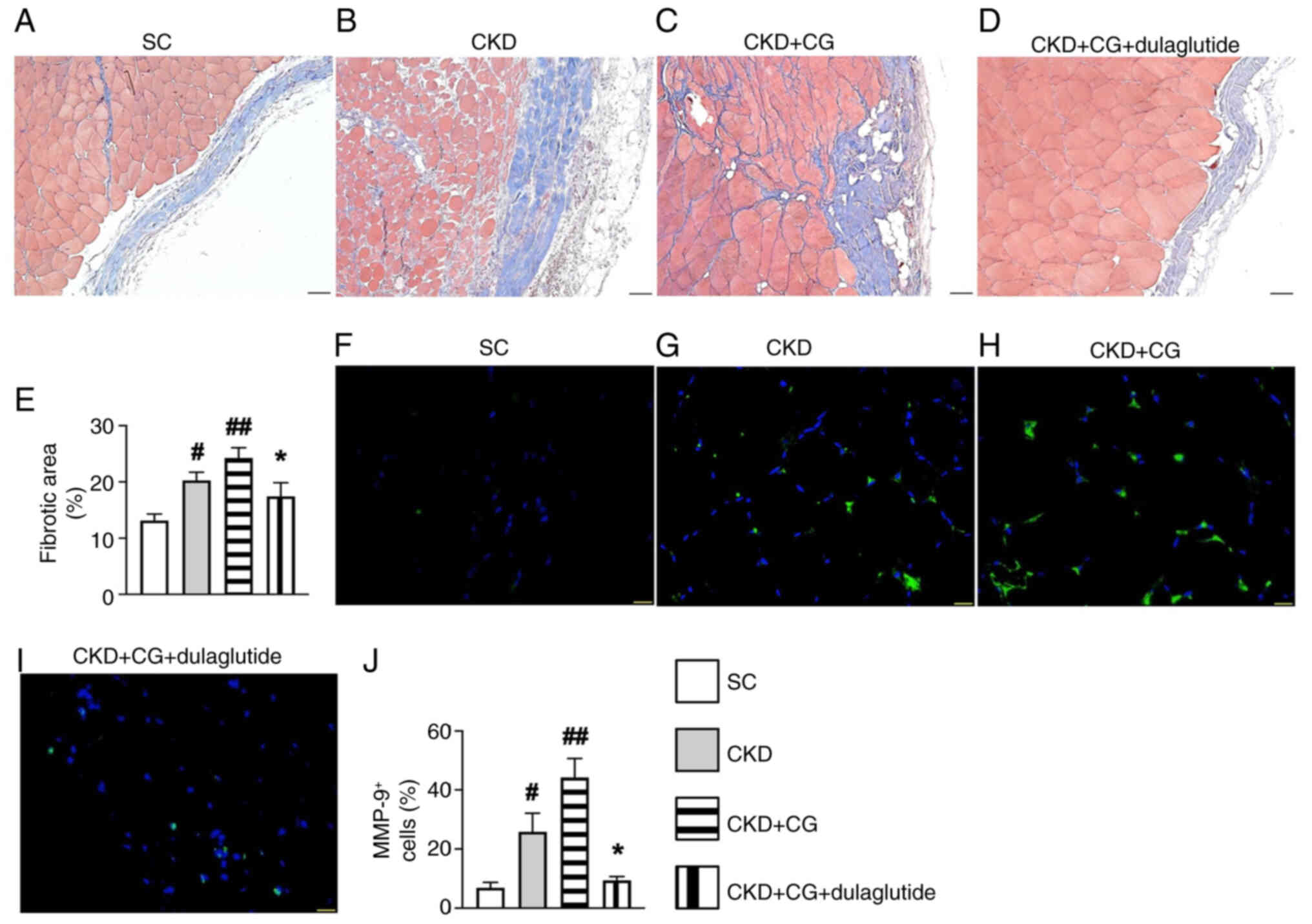 Fibrosis and inflamamotry cell
infiltration in the rat peritoneum by day 42 after CKD induction.
Microscopic findings (magnification, ×400) of Masson's trichrome
staining, which was used to identify the fibrotic area (blue), in
the (A) SC group, (B) CKD group, (C) CKD + CG group and (D) CKD +
CG + dulaglutide group. (E) Percentage of fibrotic area.
Microscopic findings (magnification, ×400) of immunohistochemistry,
which was performed to detect the expression levels of MMP-9
(green), in the (F) SC group, (G) CKD group, (H) CKD + CG group and
(I) CKD + CG + dulaglutide group. (J) Number of positively stained
MMP-9 cells. Scale bar, 20 µm. All statistical analyses were
performed by one-way ANOVA, followed by Bonferroni's multiple
comparisons post hoc test (n=6/group). #P<0.05,
##P<0.01 vs. SC; *P<0.05 vs. CKD. CG,
chlorhexidine gluconate; CKD, chronic kidney disease; SC, sham
control.