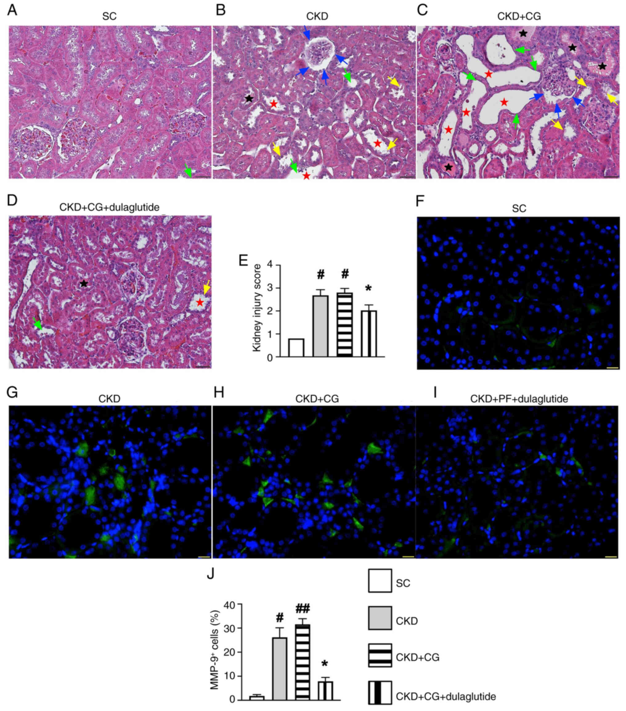 Quantitative evaluation of kidney
injury score and inflammatory cell infiltration in the kidney
parenchyma by day 42 after CKD induction. Microscopic examination
(magnification, ×200x; hematoxylin and eosin staining)
demonstrating an increased loss of brush border in renal tubules
(yellow arrows), tubular necrosis (green arrows), tubular
dilatation (red asterisk), protein cast formation (black asterisk)
and dilatation of Bowman's capsule (blue arrows) in the CKD group
than in the other groups. Scale bar, 50 µm. Images from the
(A) SC group, (B) CKD group, (C) CKD + CG group and (D) CKD + CG +
dulaglutide group. (E) Kidney injury scores. Microscopic findings
(magnification, ×400) of immunofluorescence staining, which was
performed to assess the cellualr expression of MMP-9 (green). Scale
bar, 20 µm. Images of the (F) SC group, (G) CKD group, (H)
CKD + CG group and (I) CKD + CG + dulaglutide group. (J) Number of
MMP-9+ cells. Statistical analyses were performed by (E)
Kruskal-Wallis's test and Dunn's post hoc test or (J) one-way
ANOVA, followed by Bonferroni's multiple comparisons post hoc test
(n=6/group). #P<0.05, ##P<0.01 vs. SC;
*P<0.05 vs. CKD. CG, chlorhexidine gluconate; CKD,
chronic kidney disease; PF, peritoneal fibrosis; SC, sham
control.