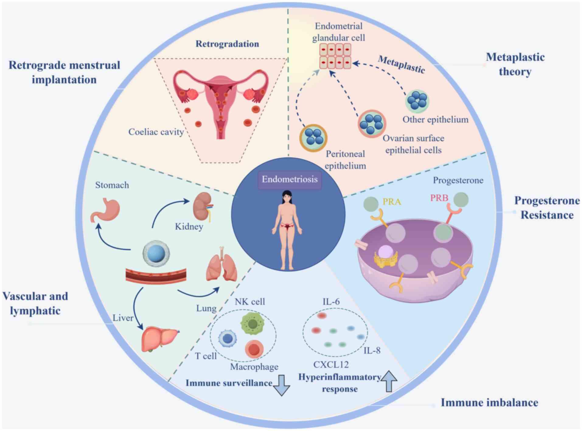 Endometriosis mechanism map. This
chart integrates several key pathogenic mechanisms of endometriosis
and elucidates the process of formation, survival, and pathological
effects of ectopic endometrial tissue in the pelvis. The retrograde
implantation theory proposes that endometrial fragments reflux
through the fallopian tubes during menstruation and adhere to the
peritoneal or ovarian surfaces. The metaplastic theory suggests
that epithelial cells, including peritoneal and ovarian cells,
transform into endometrioid cells under inflammation or hormonal
stimulation. The vascular and lymphatic spreading theory posits
that endometrial cells migrate through the vascular or lymphatic
systems to distant organs (such as the lungs, stomach or kidneys).
In addition, ectopic endometriotic tissue at ovarian or peritoneal
sites exhibits luteinizing hormone resistance, with endothelium
dominated by PRA subtypes and an elevated PRA/PRB ratio, leading to
defective decidual transformation. Finally, immune imbalance in
which immune surveillance is diminished and hyperinflammatory
response is enhanced, leads to an in vivo immune imbalance.
PRA, progesterone receptor A; PRB, progesterone receptor B; NK,
natural killer; IL, interleukin; CXCCL12, C-X-C motif chemokine
ligand 12.