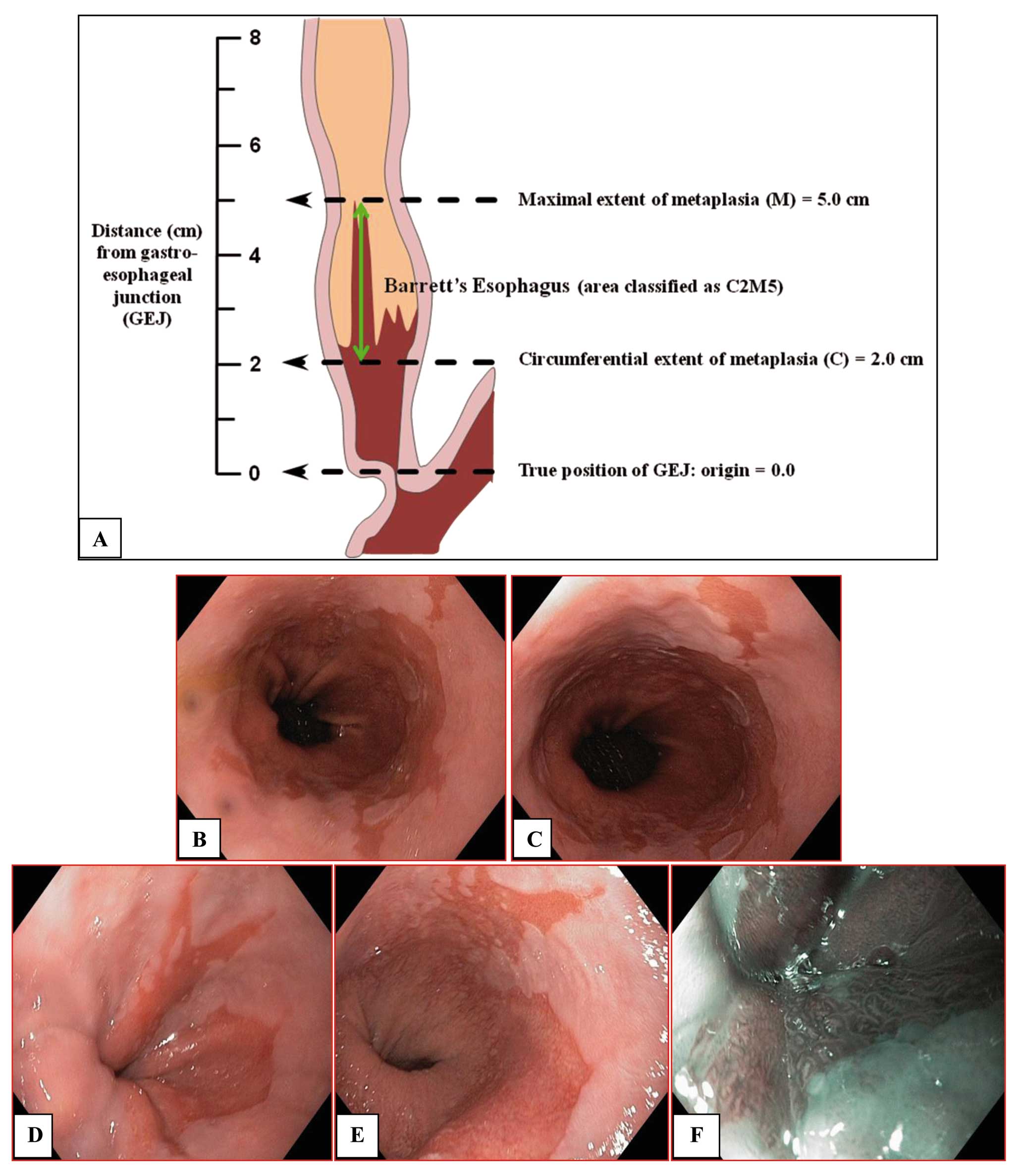 Barrett's esophagus and esophageal cancer: An overview