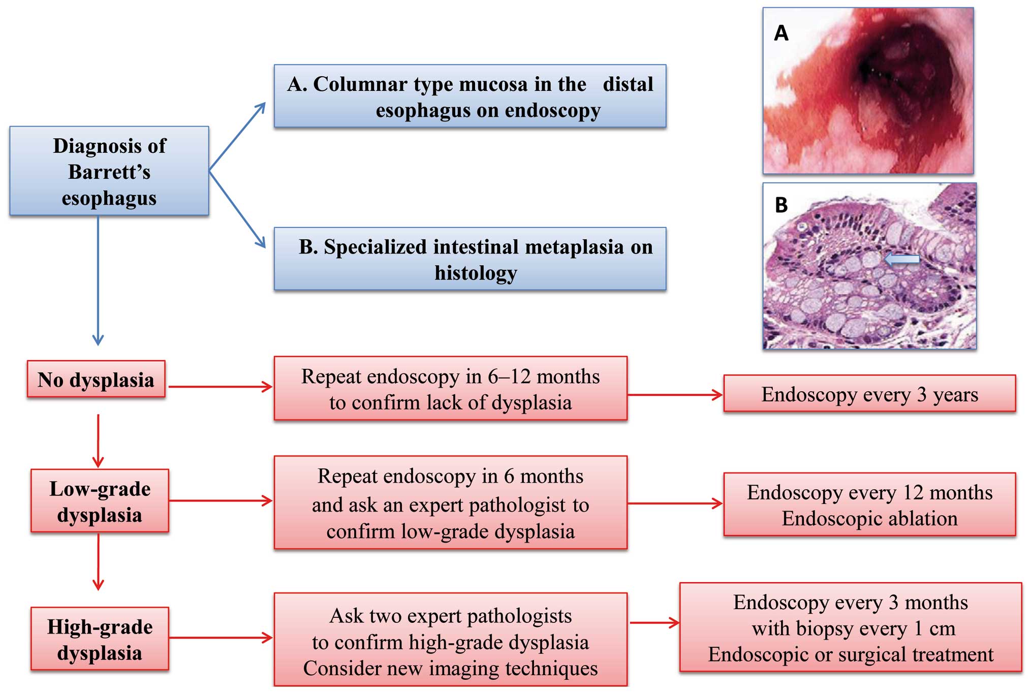 Barrett's Esophagus Prague Classification