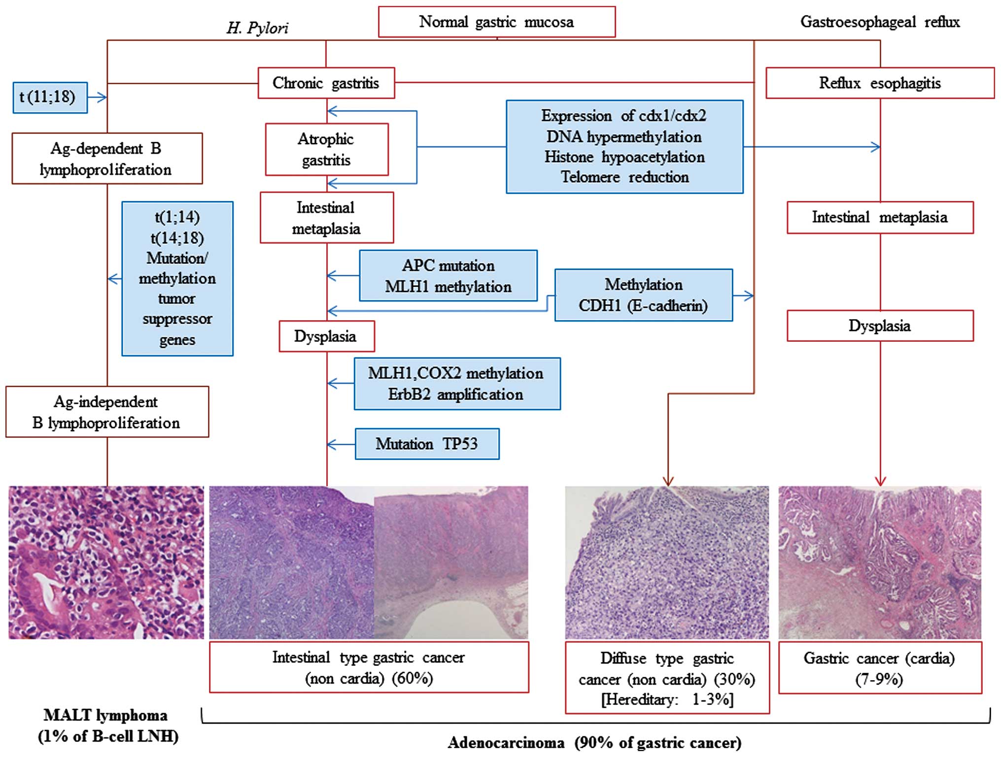 Cancer gastric ereditar difuz (HDGC)-mutatii CDH1