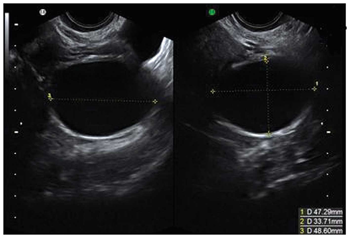 The Characteristic Ultrasound Features Of Specific Types Of Ovarian Pathology Review