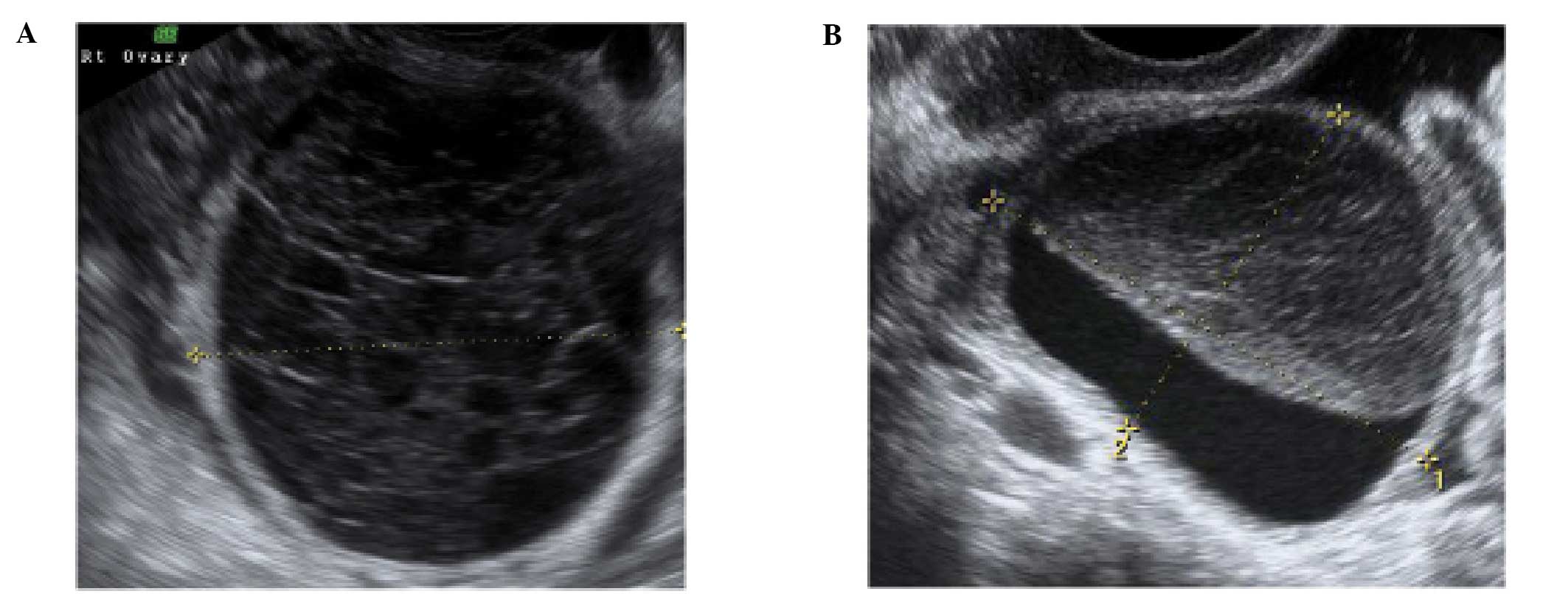 Transvaginal Ultrasound Ovarian Cysts