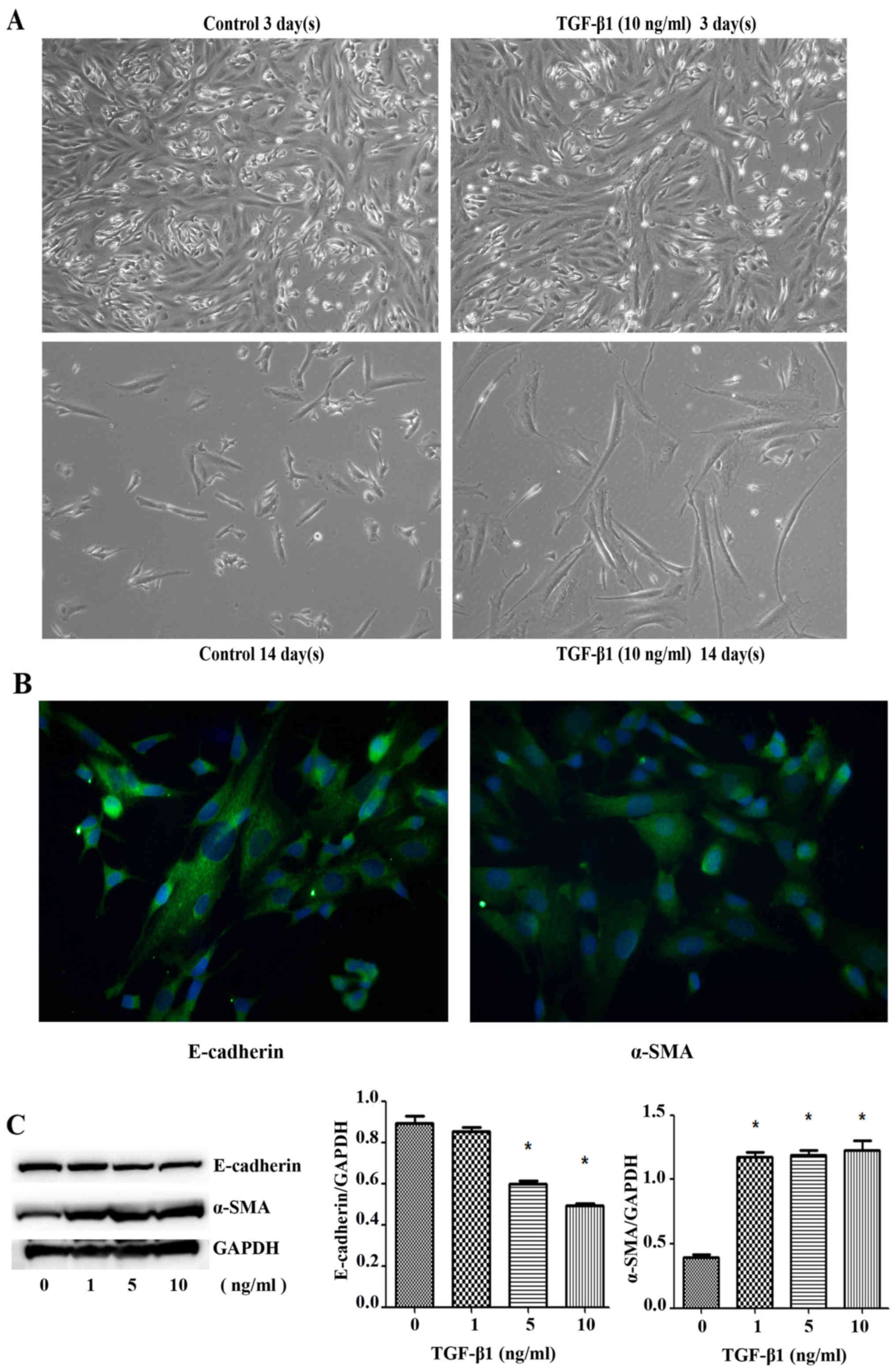 The Mechanism Of Epithelial Mesenchymal Transition Induced By Tgf B1 In Neuroblastoma Cells