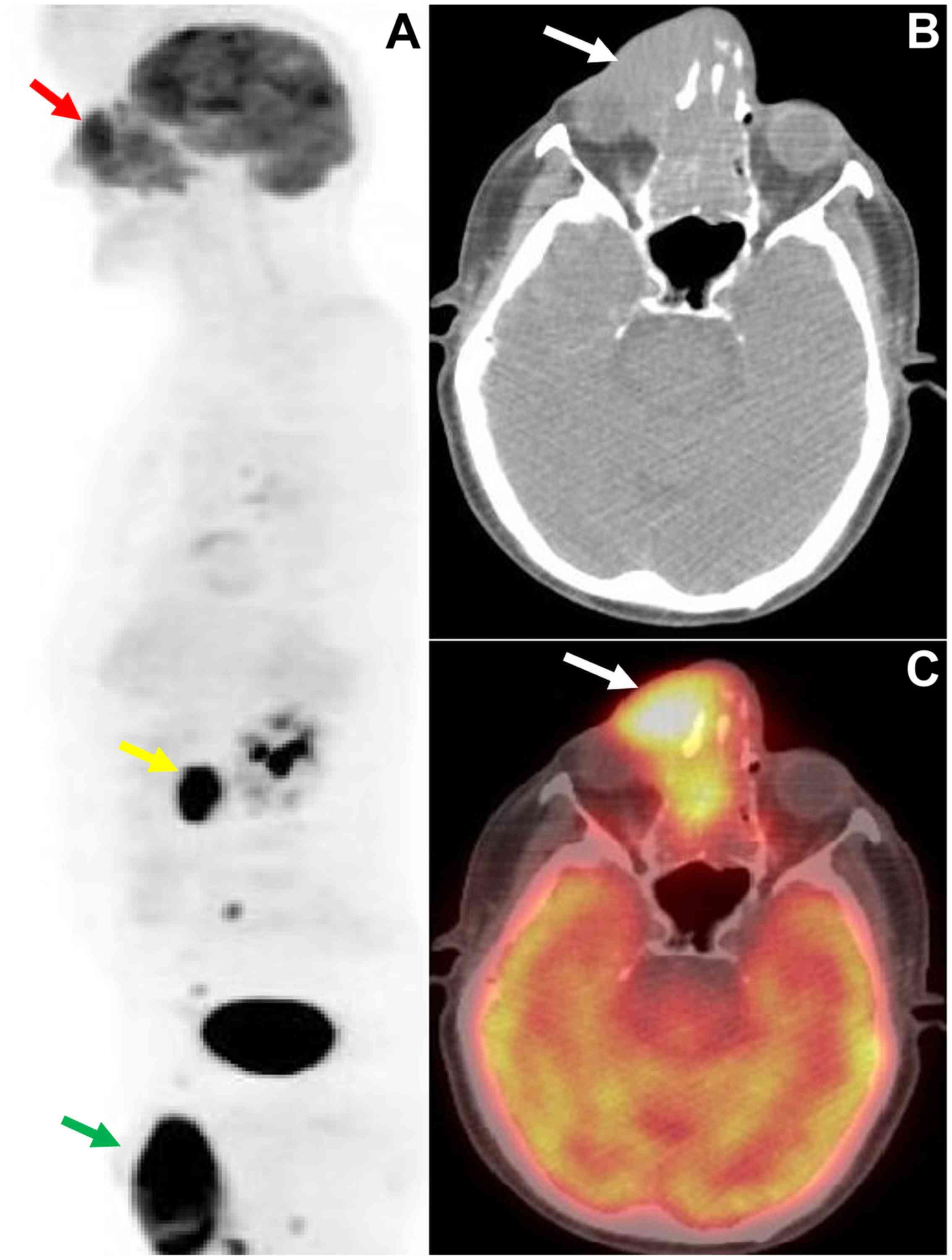 Pet Ct And Pet Mri In Ophthalmic Oncology Review