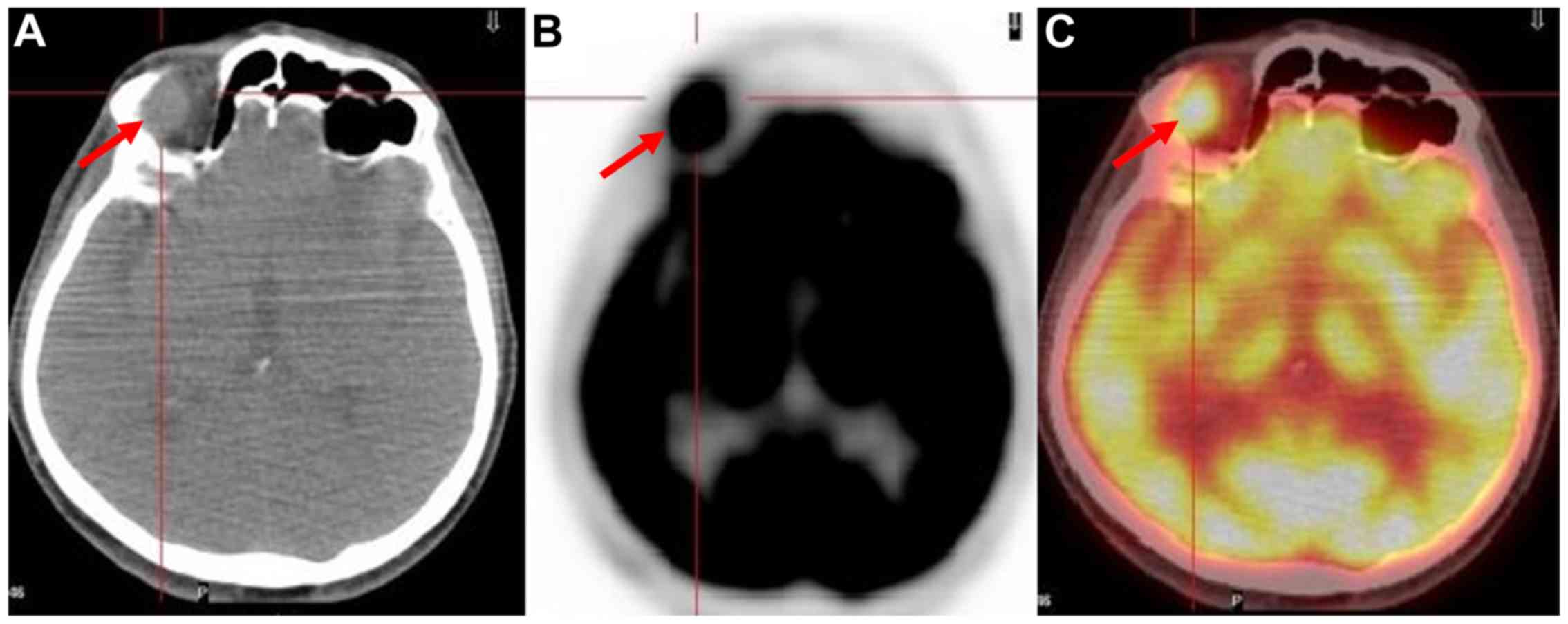 sarcomatoid carcinoma mesothelioma