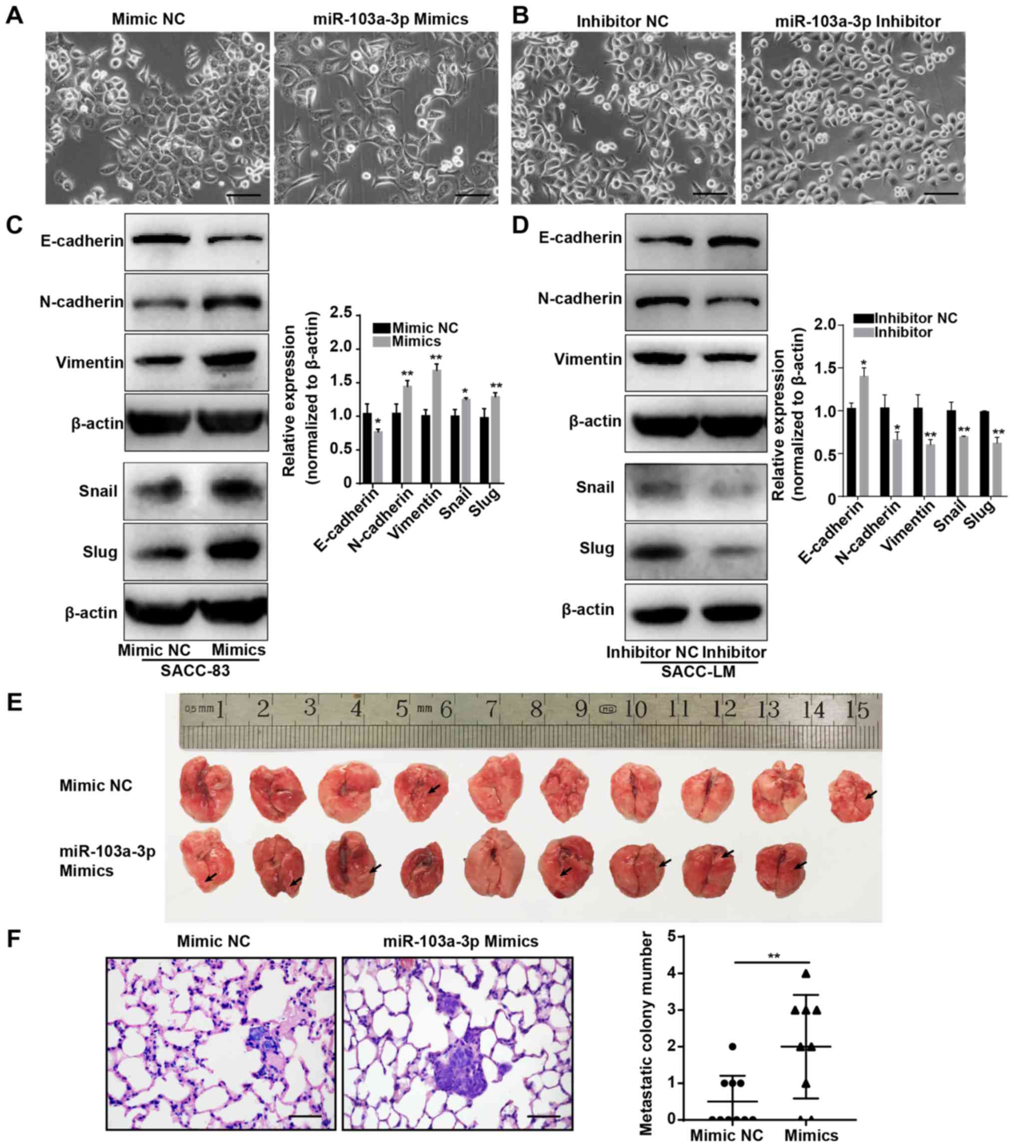 Microrna‑103a‑3p Promotes Metastasis By Targeting Tpd52 In Salivary Adenoid Cystic Carcinoma