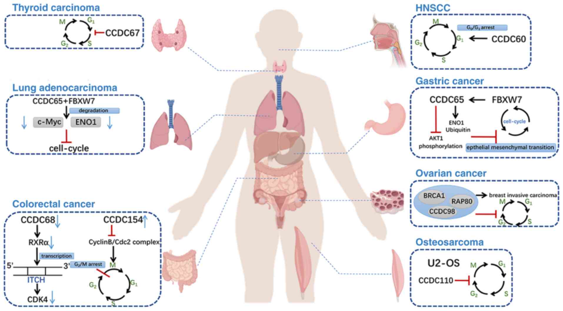 The roles of CCDC family types of
cancer. The CCDC family exhibits varied tumor-regulatory roles. In
lung adenocarcinoma, CCDC65 recruits FBXW7 to degrade c-Myc and
ENO1, inhibiting cell cycle signaling. In gastric cancer, CCDC65
degrades ENO1, reduces AKT1 phosphorylation, and suppresses cell
cycle and EMT signaling. In thyroid cancer, CCDC67 induces
apoptosis and inhibits metastasis by blocking G1/S
transition. In ovarian cancer, CCDC98 regulates BRCA1 dependent DNA
damage response. In colorectal cancer, CCDC68 downregulation
promotes CDK4 degradation, inhibiting G0/G1
transition. CCDC154 overexpression blocks G2/M phase,
while CCDC60 and CCDC110 induce G0/G1 and
G2/M arrests in head and neck squamous cell carcinoma
and osteosarcoma, respectively. These findings highlight the
potential role of CCDC137 in the tumor microenvironment. CCDC,
coiled-coil domain-containing protein; FBXW7, F-Box and WD repeat
domain containing 7; c-Myc, cellular Myelocytomatosis; ENO1,
enolase 1; EMT, epithelial-mesenchymal transition; BRCA1, breast
cancer gene 1; CDK4, cyclin-dependent kinase 4; HNSCC, head and
neck squamous cell carcinoma; RAP80, receptor-associated protein
80; RxRa, retinoid X receptor α, Cdc2, cell division cycle 2;
U2-OS, U-2 osteosarcoma.