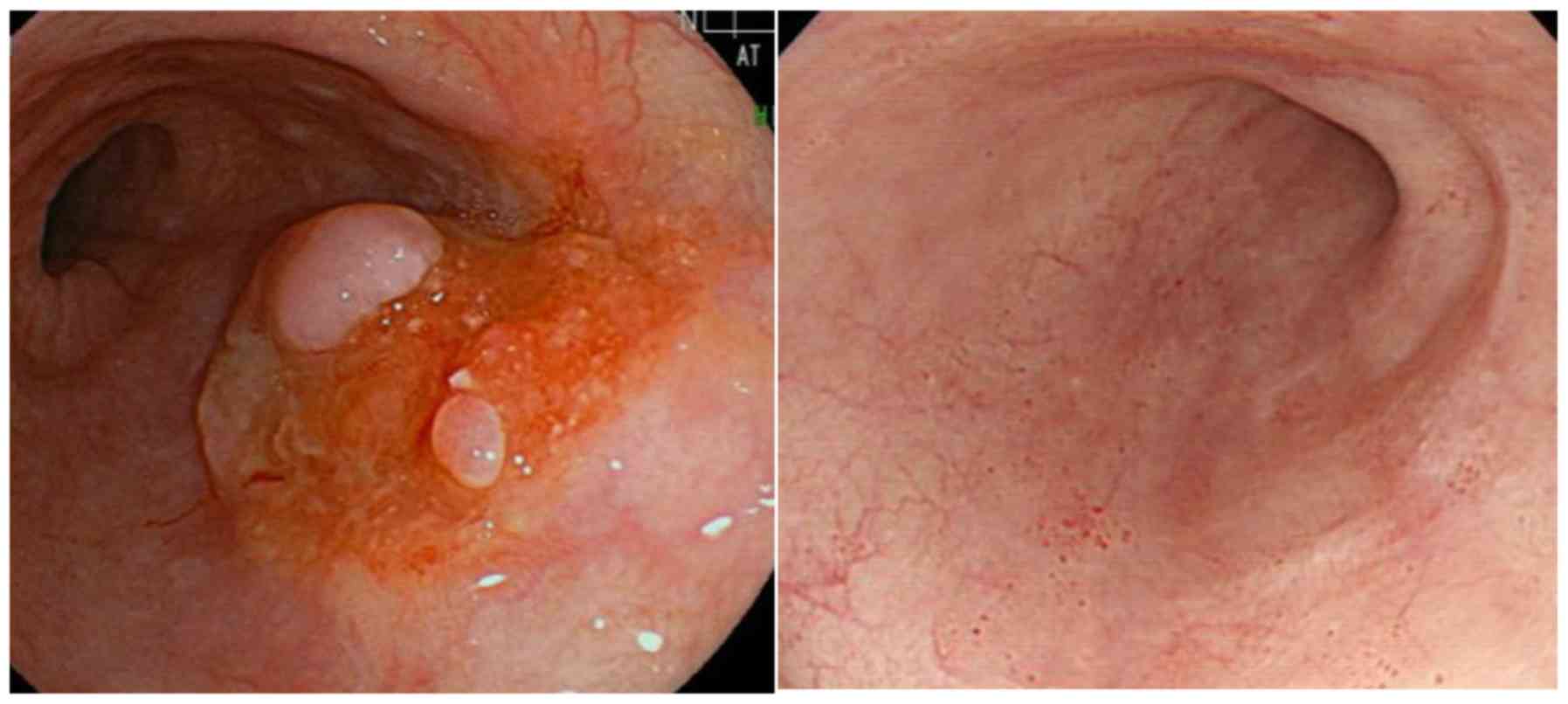 Chemoradiotherapy with FOLFOX for esophageal squamous cell