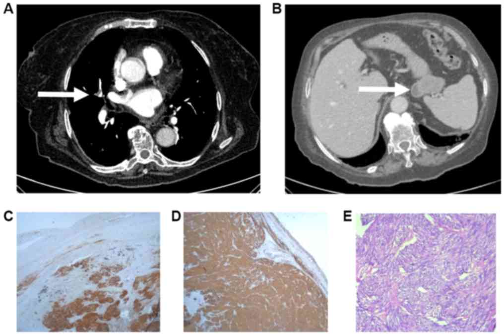 can a ct angiogram detect lung cancer