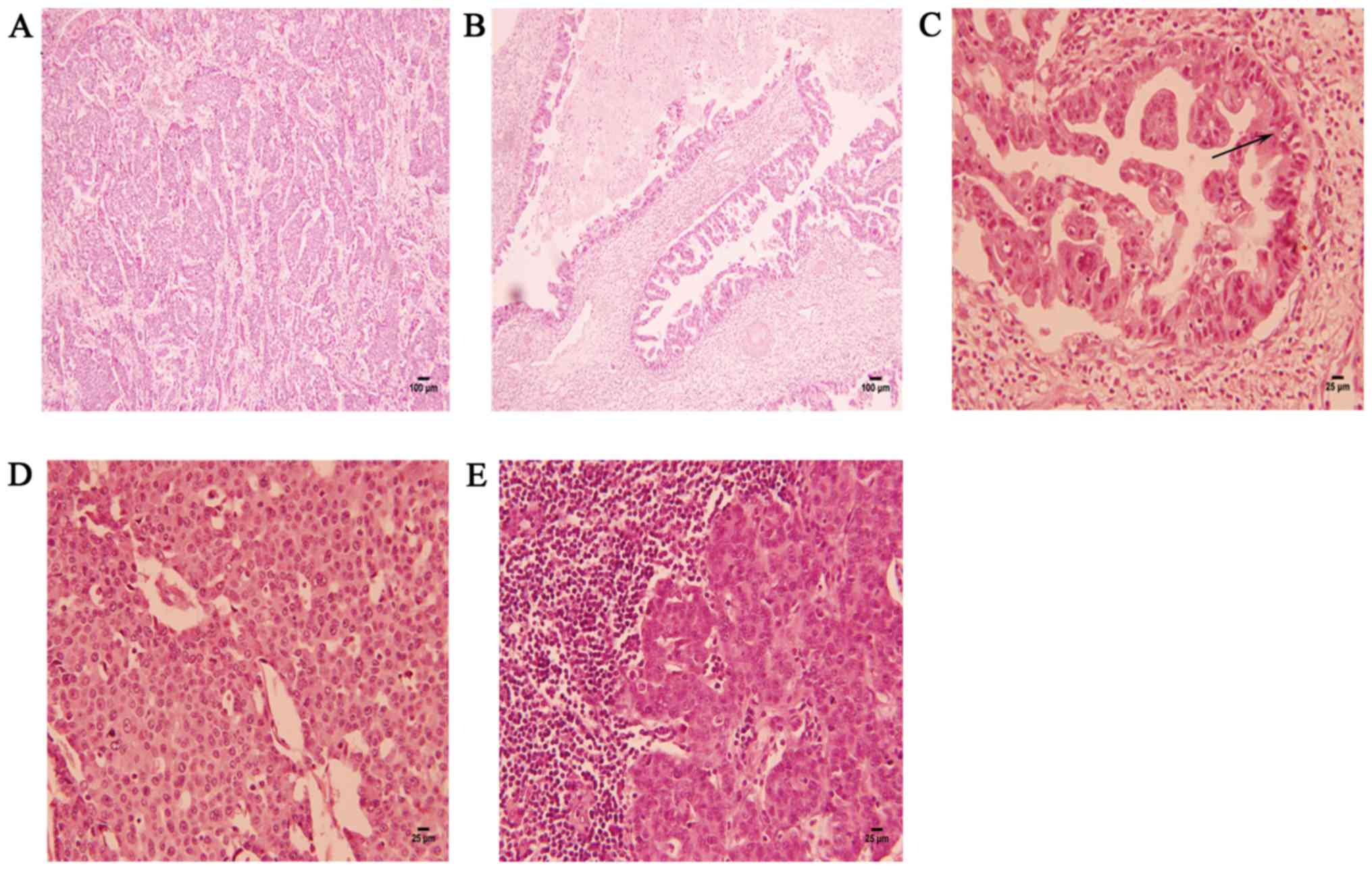 Mixed Adenoneuroendocrine Carcinoma Of The Liver A Rare Case Report
