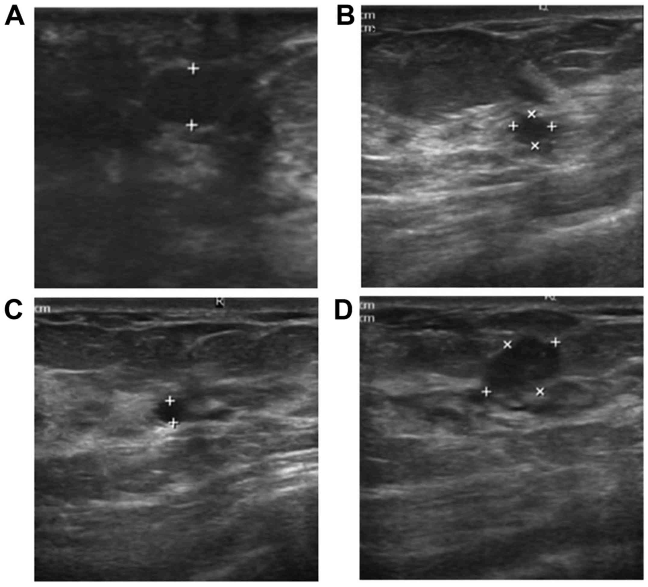 multiplex intraductalis papilloma)