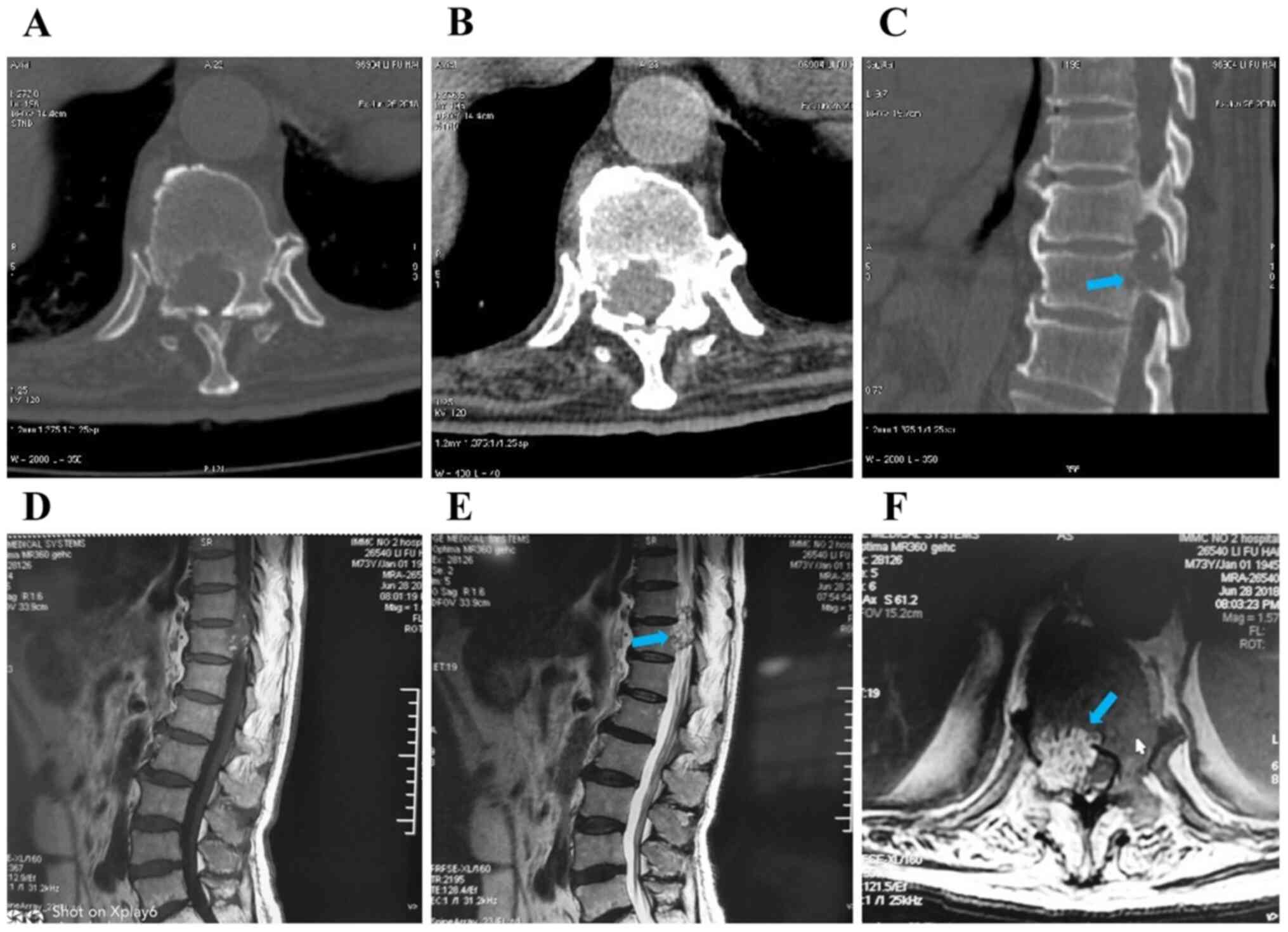 metastatic cancer of the sacrum survival rate hpv high risk during pregnancy