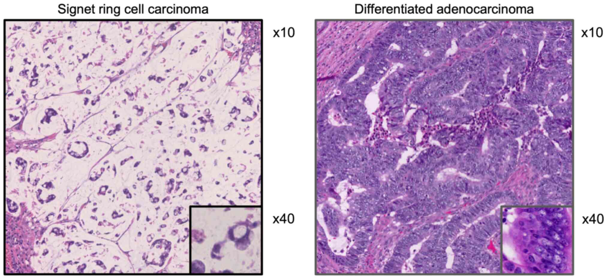 Signet-ring Cell Carcinoma of the Stomach Metastasizing to Renal Cell  Carcinoma: a Case Report and Review of the Literature