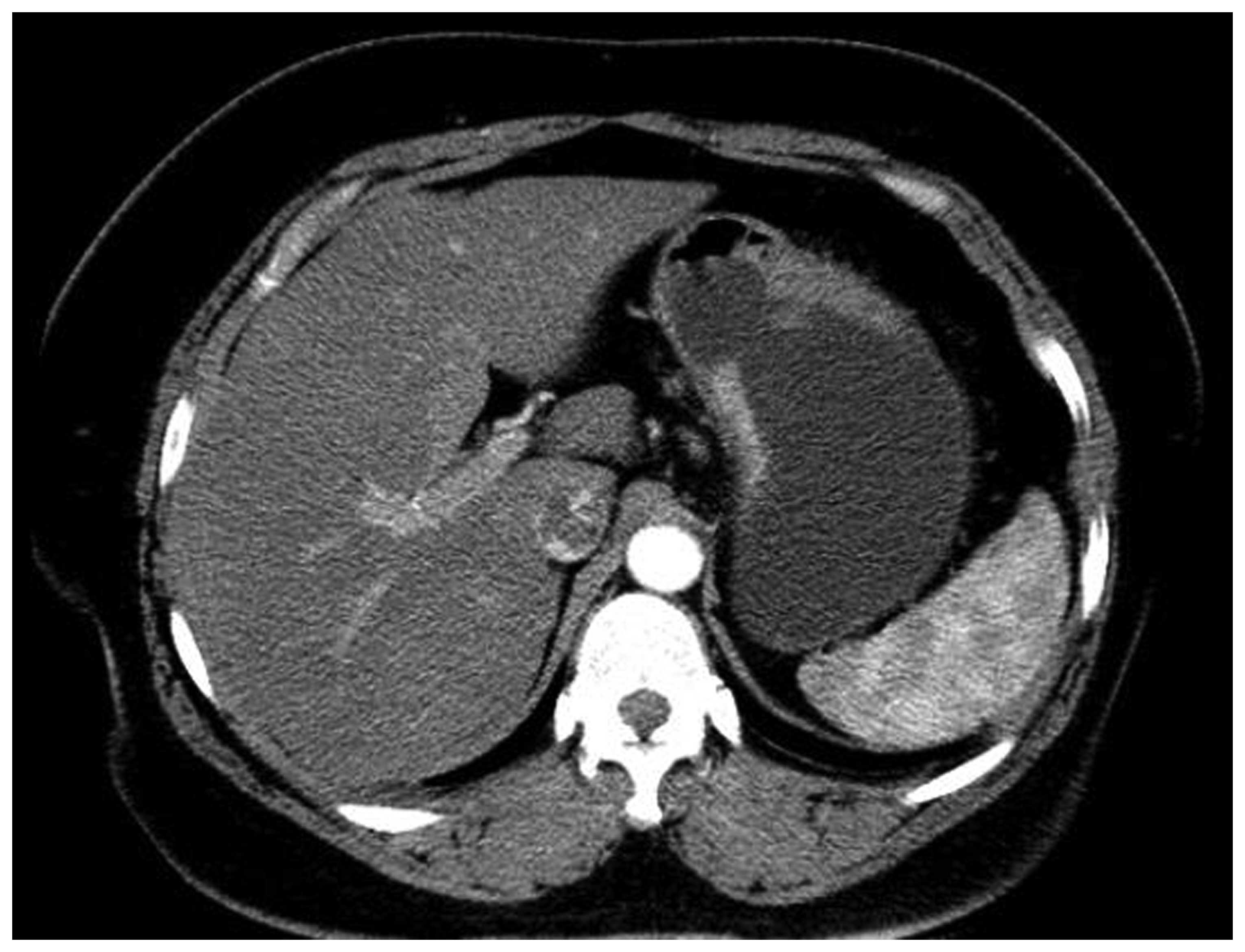 Gastric cancer on ct scan. Abdominal cancer nodules