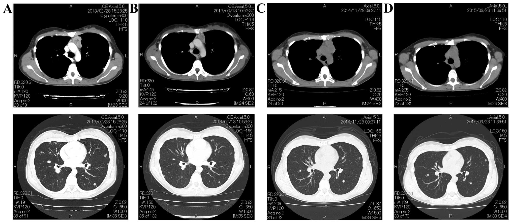 ckit mutationpositive advanced thymic carcinoma successfully treated