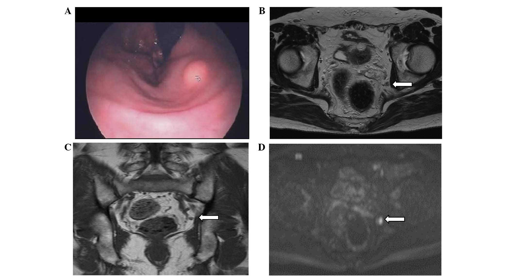 A case of rectal carcinoid, 7 mm in diameter, with skip metastasis to