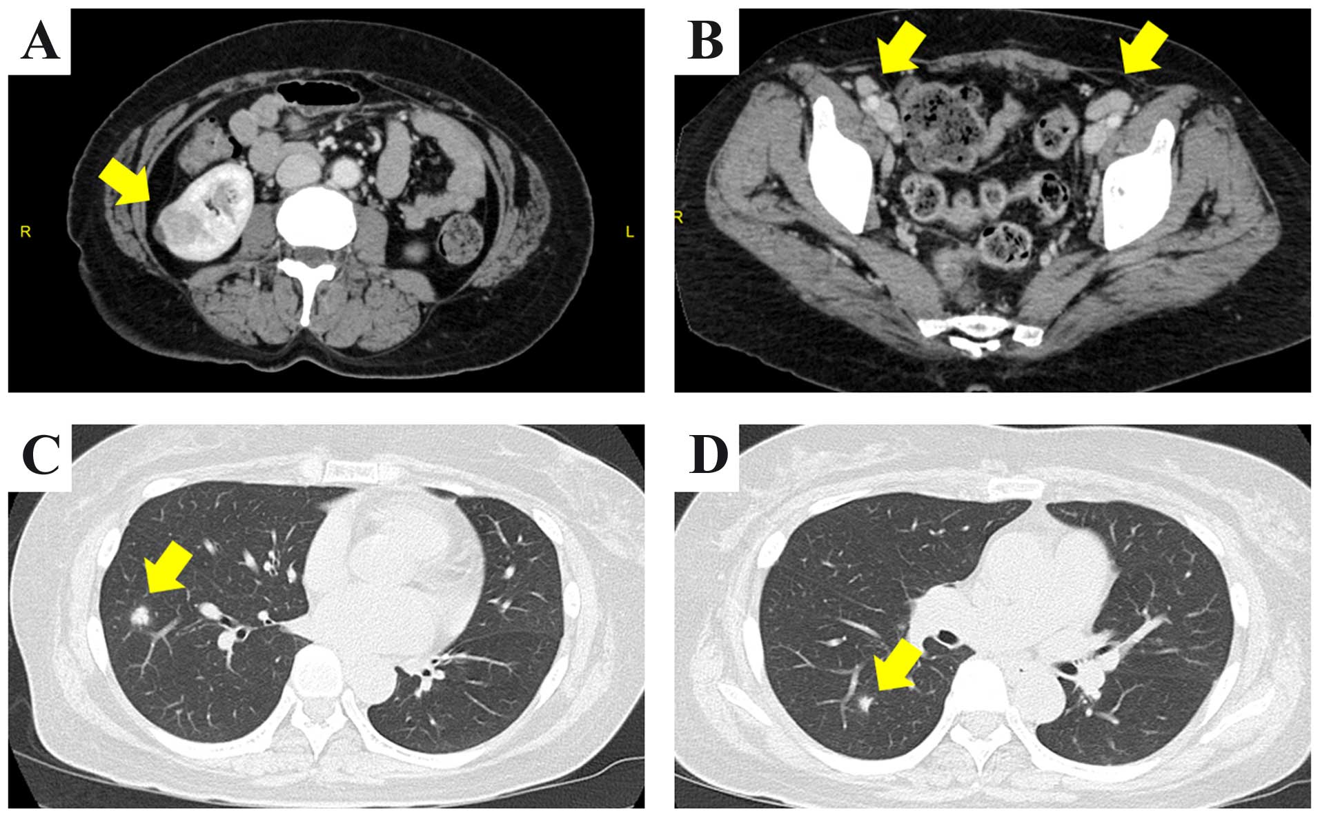 Spontaneous Regression Of Multiple Pulmonary Nodules In A Patient With