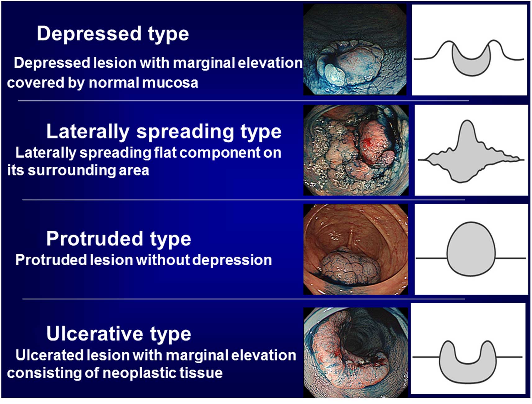 Colorectal Cancer Classification