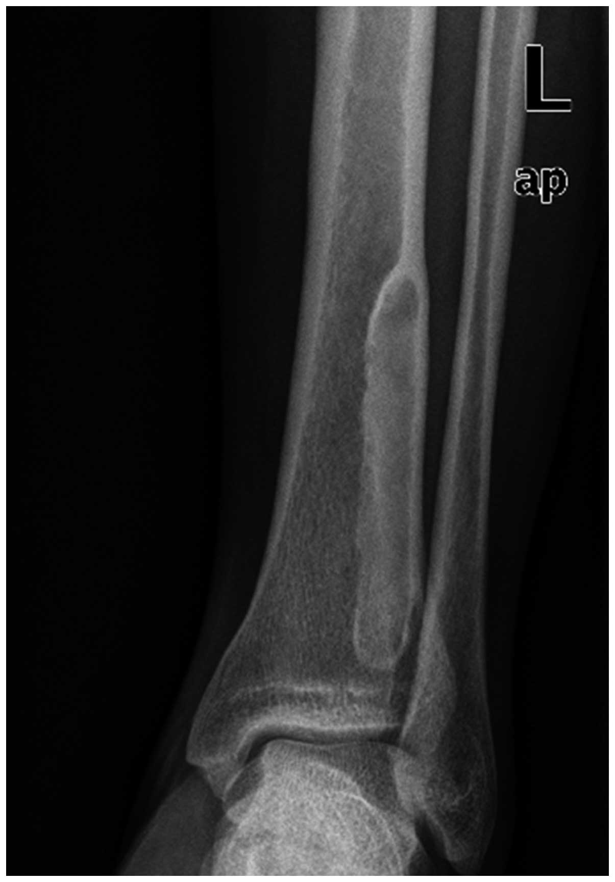 Desmoplastic fibroma of the distal tibia: A case report of a minimally