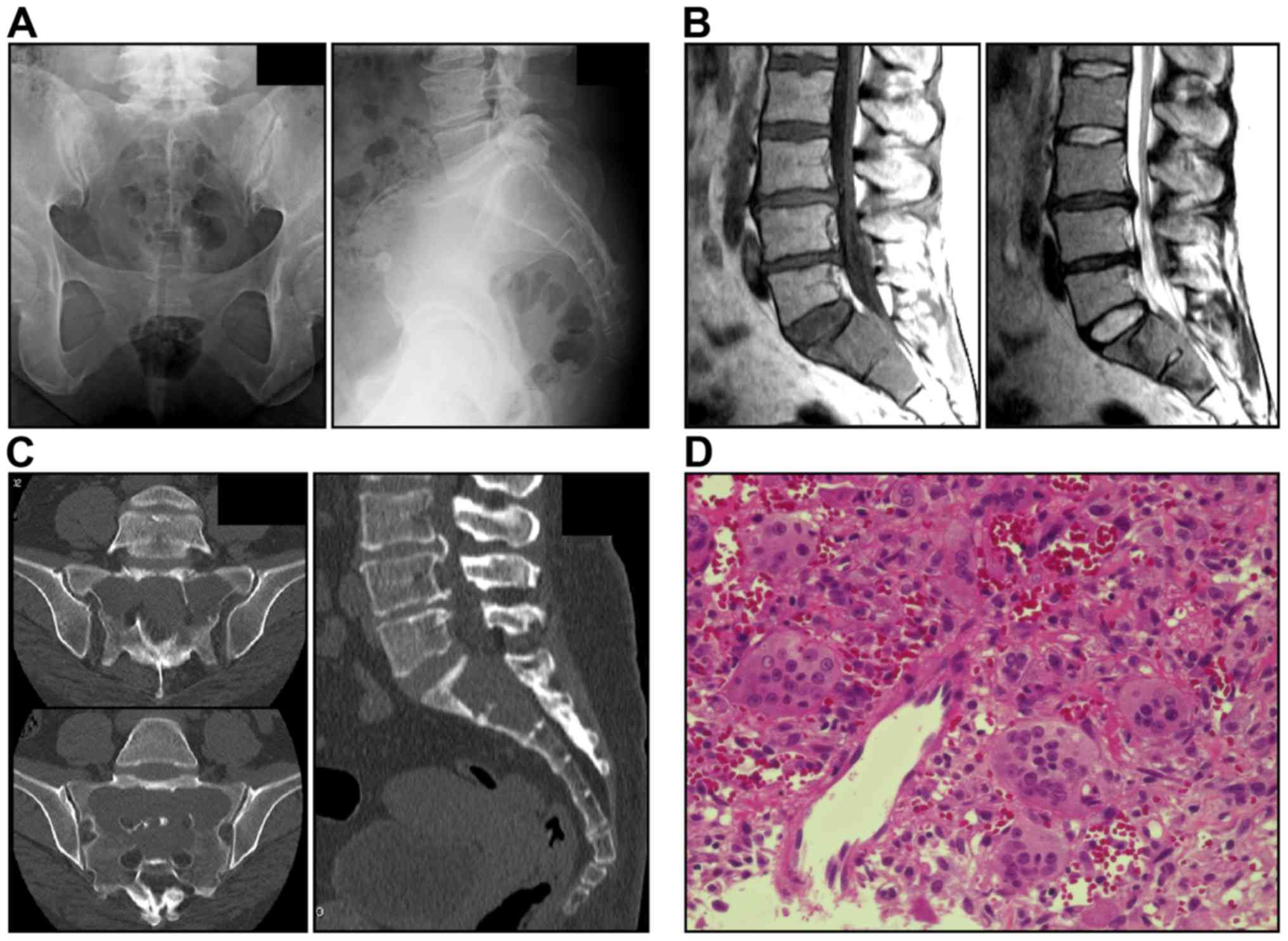 Successful treatment with denosumab in a patient with sacral giant cell