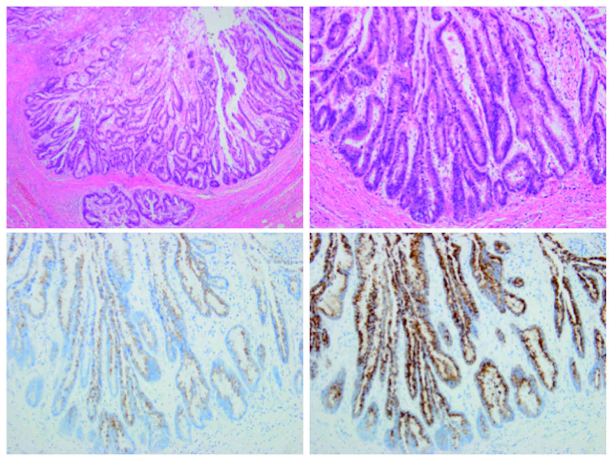 Intraductal papillary mucinous neoplasm