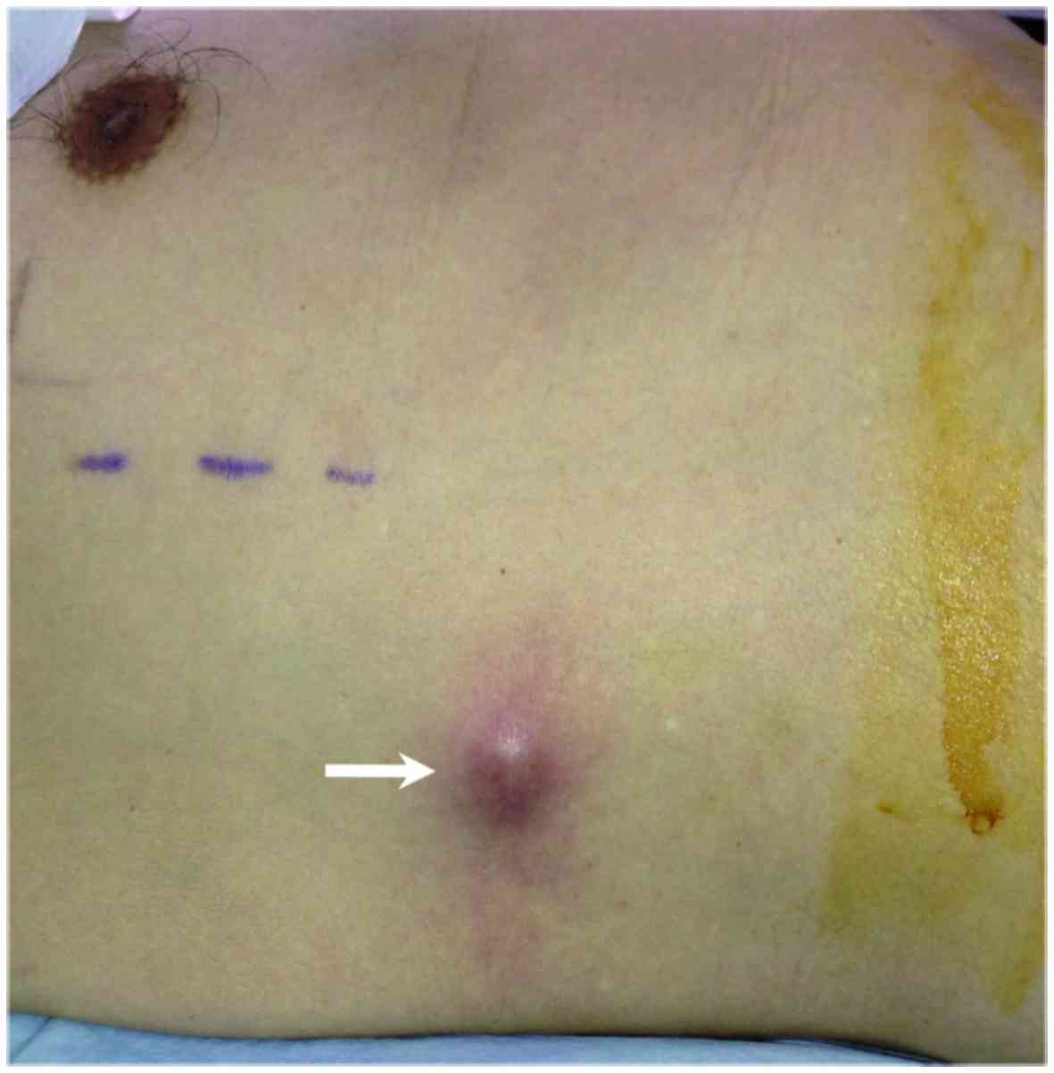 Abdominal cancer mets, Peritoneal Metastases papiloma laringeo juvenil