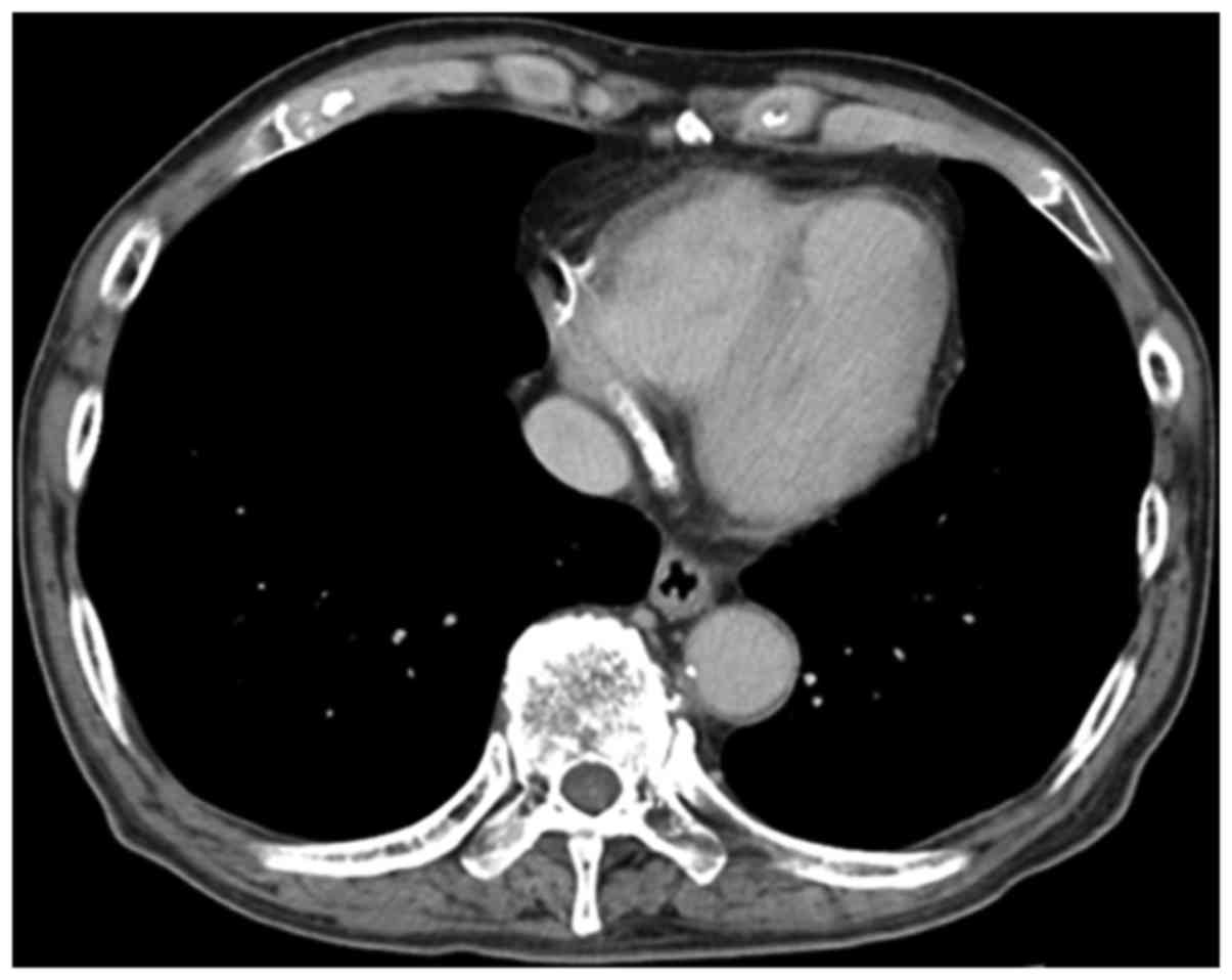 Rapid occurrence of left ventricular thrombus associated with platinum‑based chemotherapy plus ...