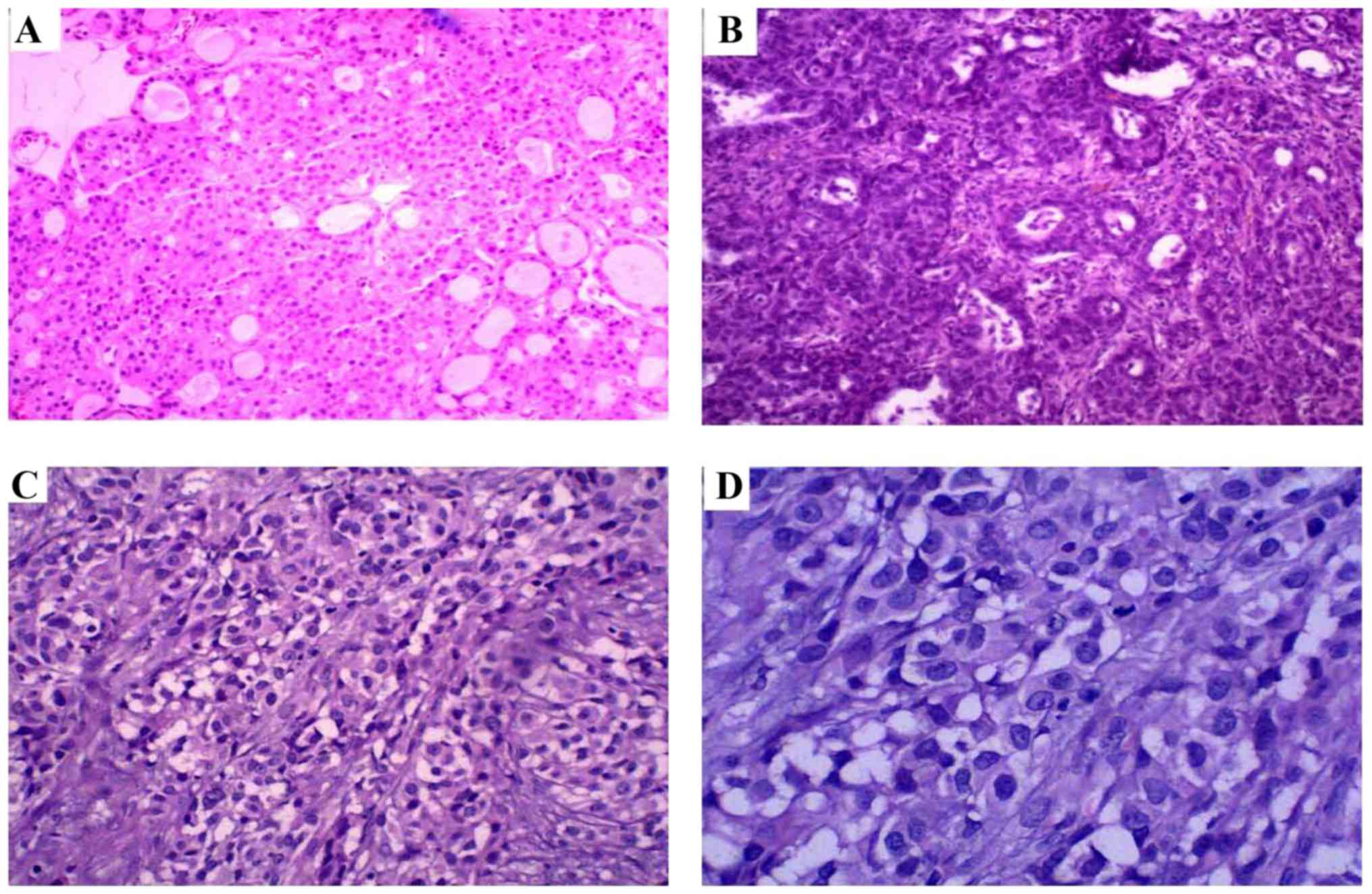 tratamiento para derrame cerebral hemorragico