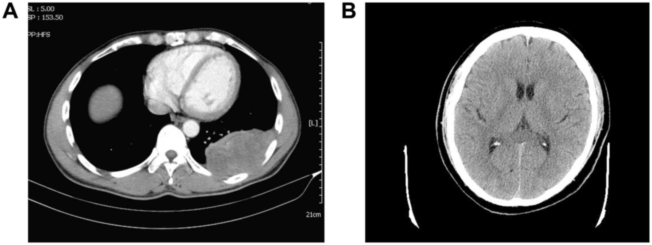 can lung cancer spread to your liver